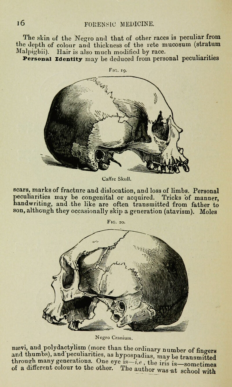 The skin of the Negro and that of other races is peculiar from the depth of colour and thickness of the rete mucosum (stratum Malpigbii). Hair is also much modified by race. Personal Identity may be deduced from personal peculiarities Fig. ro. Caffre Skull. scars, marks of fracture and dislocation, and loss of limbs. Personal Eeculiarities may be congenital or acquired. Tricks 'of manner, andwriting, and the like are often transmitted from father to son, although they occasionally skip a generation (atavism). Moles Negro Craniun nasvi, and polydactylism (more than the ordinary number of fingers and thumbs), and peculiarity, as hypospadias, may be transmitted throush many generations. One eye is—i e the iris ,'0 =««, f of a differentycSolour to the other/ The auC^rXKfflk