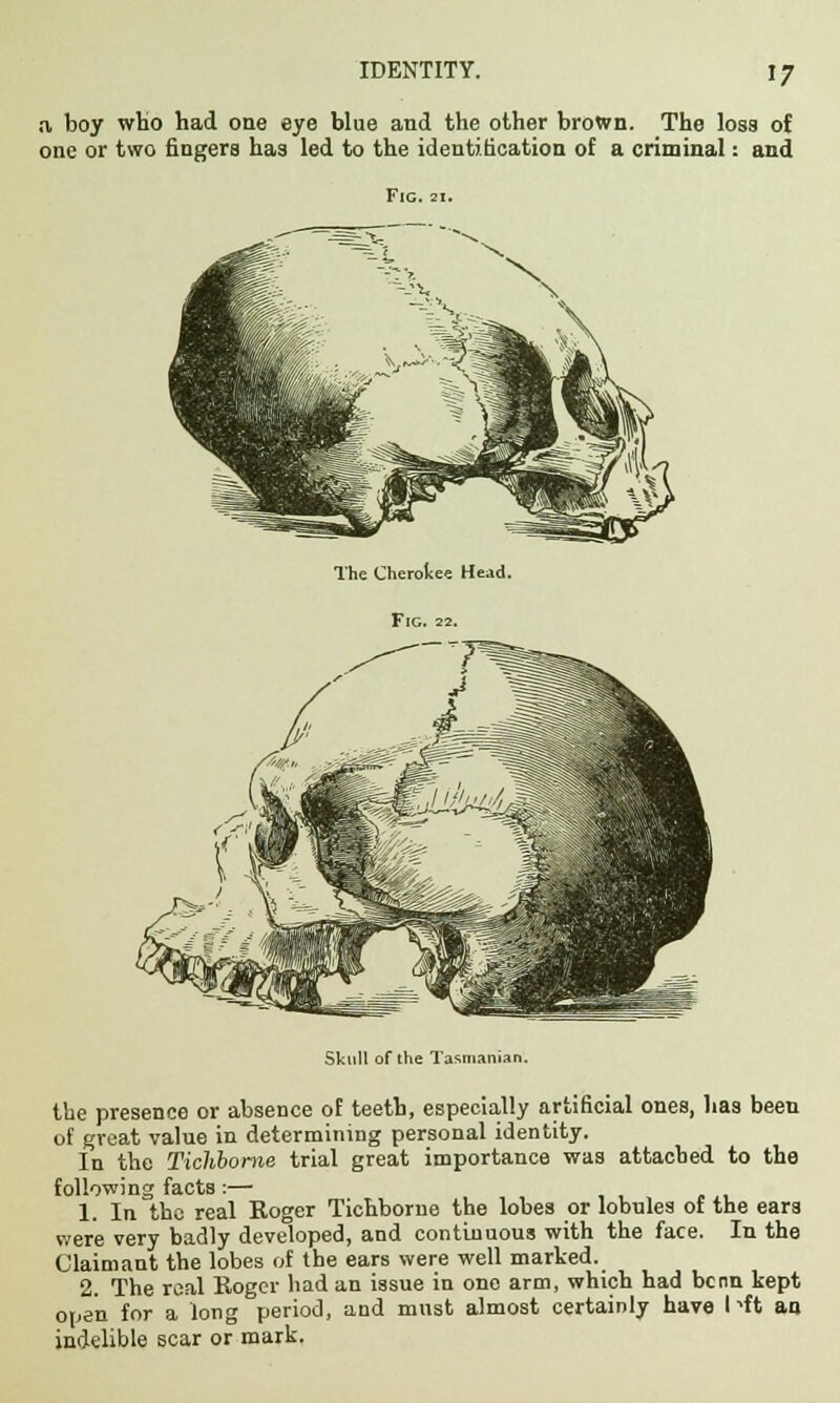 a boy who had one eye blue and the other brown. The loss of one or two fingers has led to the identification of a criminal: and Fig. 21. The Cherokee Head. Fig. 22. Skull of the Tasmania!!. the presence or absence oE teeth, especially artificial ones, has been of great value in determining personal identity. In the Tichbome trial great importance was attached to the following facts:— 1. In the real Roger Tichbome the lobes or lobnles of the ears were very badly developed, and continuous with the face. In the Claimant the lobes of the ears were well marked. 2. The real Roger had an issue in one arm, which had benn kept open for a long period, and must almost certainly have I'•ft an indelible scar or mark.