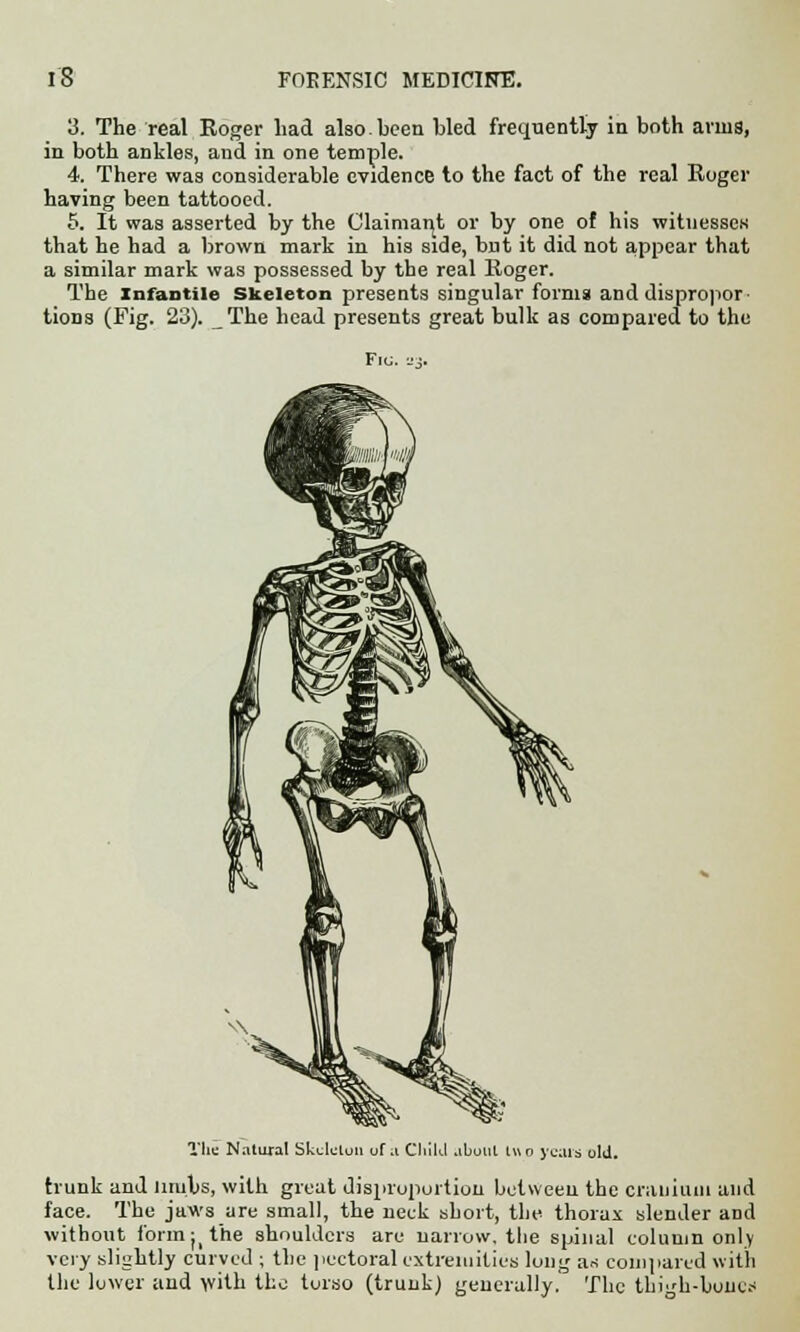 3. The real Roger had also.been bled frequently in both anus, in both ankles, and in one temple. 4. There was considerable evidence to the fact of the real Roger having been tattooed. 5. It was asserted by the Claimant or by one of his witnesses that he had a brown mark in his side, but it did not appear that a similar mark was possessed by the real Roger. The Infantile Skeleton presents singular forma and dispropor tions (Fig. 23). The head presents great bulk as compared to the FlCJ. 23. Tim Natural Skeleton uf a Child aboul two years old. hunk and limbs, with great disproportion between the cranium and face. The jaws are small, the neck short, the thorax slender and without form ^ the shoulders are narrow, the spinal column only very slightly curved ; the pectoral extremities long an compared with the lower and with the torso (trunk) generally. The thigh-bone.-'