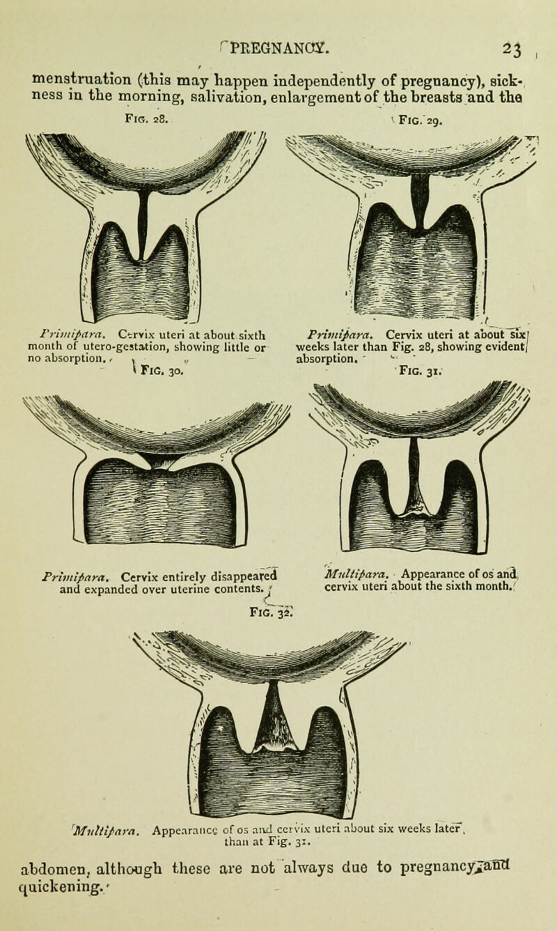 menstruation (this may happen independently of pregnancy), sick- ness in the morning, salivation, enlargement of the breasts and the Fig. 28. \ Fig. 29. Frimipttra, Cervix uteri at about sixth Primifara. Cervix uteri at about six! month of utero-gestation, showing little or weeks later than Fig. 28, showing evident] no absorption. - » „ absorption. ' ** * Fig. 30. Fig. 31. Primifiara. Cervix entirely disappeared and expanded over uterine contents. * FigT 3~£ Multipara. Appearance of os; anct, cervix uteri about the sixth month.' rMultifara. Appearance of os and cervix uteri about six weeks later, than at Fig. 3:. abdomen, although these are not always due to pregnancy>antt quickening.*