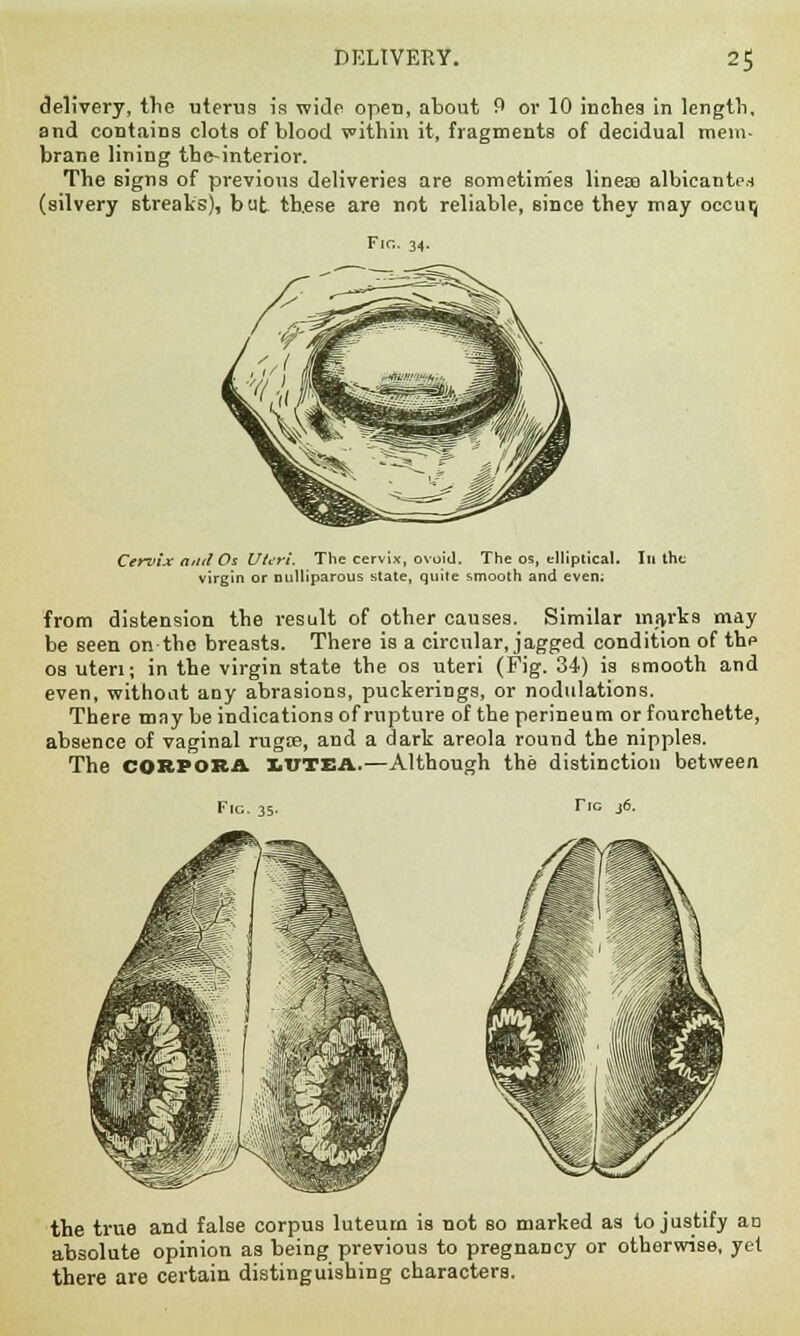 DELIVERY. 2$ delivery, trie uterus is wide open, about 9 or 10 inches in length, and contains clots of blood within it, fragments of decidual mem- brane lining the-interior. The signs of previous deliveries are sometimes linesa albicante-t (silvery streaks), but these are not reliable, since they may occuij Fir.. 34. Cervix and Os Uteri. The cervix, ovoid. The os, elliptical. In the virgin or nulliparous state, quite smooth and even; from distension the result of other causes. Similar marts may be seen on the breasts. There is a circular, jagged condition of the os uteri; in the virgin state the os uteri (Fig. 34) is smooth and even, without any abrasions, puckerings, or nodulations. There may be indications of rupture of the perineum or fourchette, absence of vaginal rugoe, and a dark areola round the nipples. The CORPORA XiUTEA.—Although the distinction between Tic j6. the true and false corpus luteura is not so marked as to justify at: absolute opinion as being previous to pregnancy or otherwise, yet there are certain distinguishing characters.