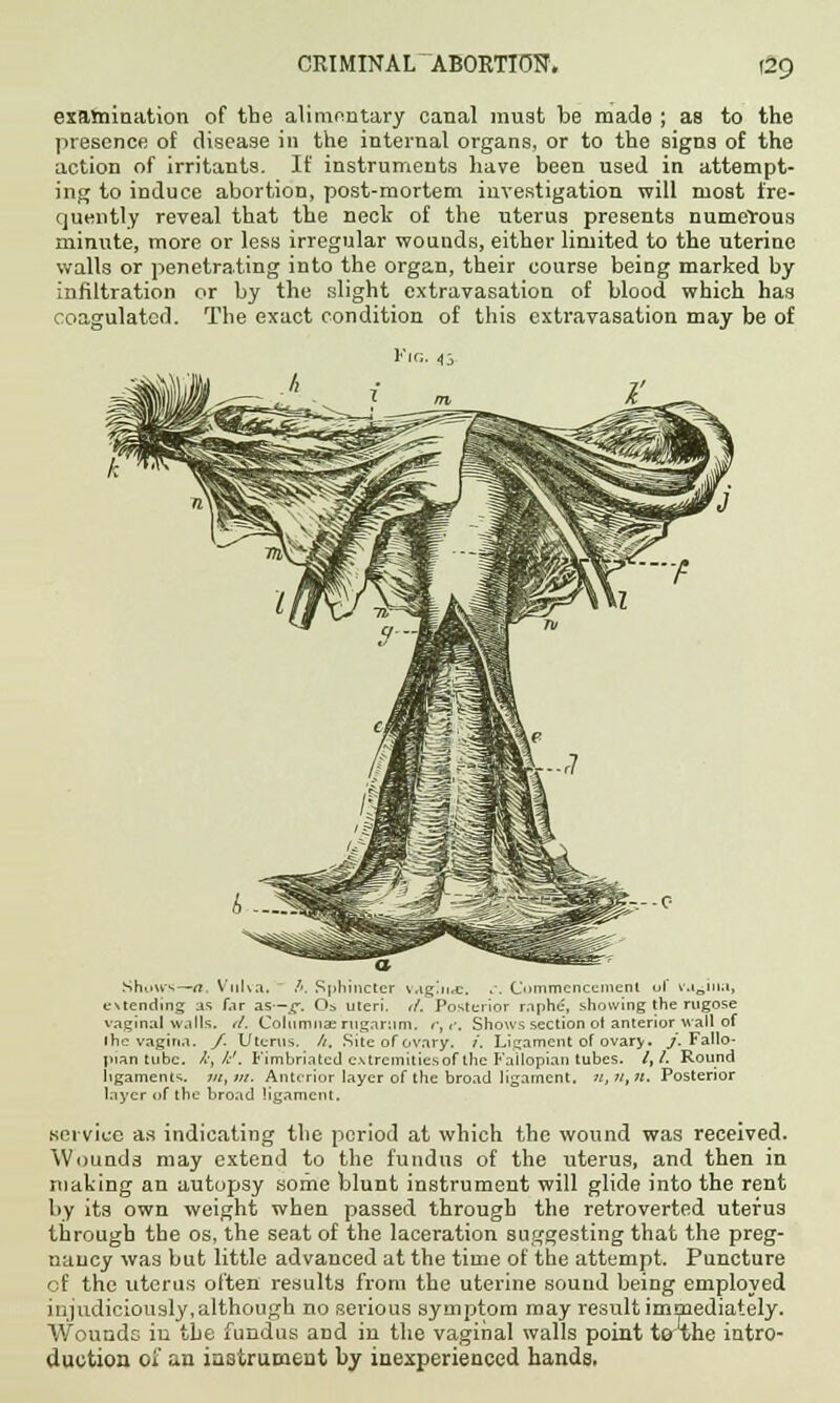 examination of the alimentary canal must be made ; as to the presence of disease in the internal organs, or to the signs of the action of irritants. If instruments have been used in attempt- ing to induce abortion, post-mortem investigation will most fre- quently reveal that the neck of the uterus presents numerous minute, more or less irregular wounds, either limited to the uterine walls or penetrating into the organ, their course being marked by infiltration or by the slight extravasation of blood which has coagulated. The exact condition of this extravasation may be of a Show*—a Vulva, /-. Sphincter vag;ii<£, .. Commencement of vagina, extending as far as—g. Os uteri, tt. Posterior raphe, showing the rugose vaginal walls, il. Columnae rugarum. r, e. Shows section of anterior wall of Ihc vagina. /. Uterus, ft. Site of ovary. /. Ligament of ovary. /. Fallo- pian tube. /',/.'. Fimbriated cxtrcmitiesof the Fallopian tubes. /,/. Round ligaments. tu,m. Anterior layer of the broad ligament. ji,ji,?i. Posterior layer of the broad ligament. service as indicating the period at which the wound was received. Wounds may extend to the fundus of the uterus, and then in making an autopsy some blunt instrument will glide into the rent by its own weight when passed through the retroverted uterus through the os, the seat of the laceration suggesting that the preg- nancy was but little advanced at the time of the attempt. Puncture of the uterus often results from the uterine sound being employed injudiciously,although no serious symptom may result immediately. Wounds in the fundus and in the vaginal walls point toxhe intro- duction oi an instrument by inexperienced hands.