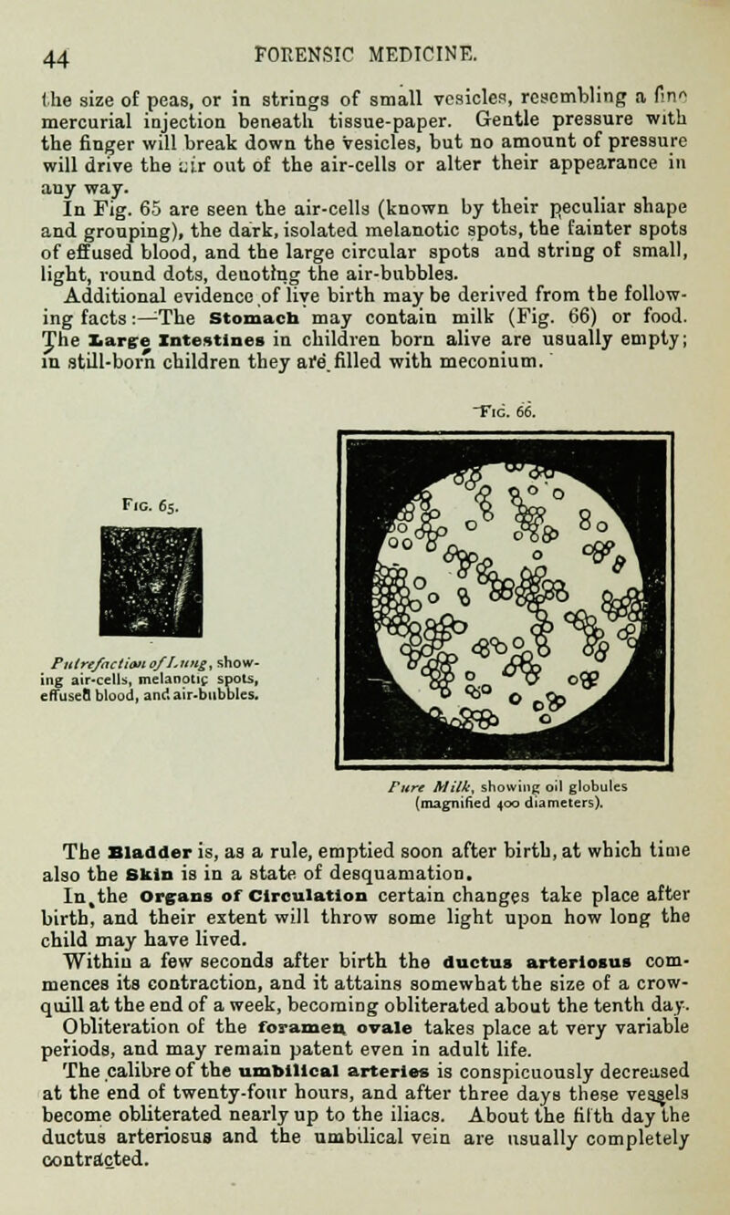 the size of peas, or in strings of small vesicles, resembling a fin* mercurial injection beneath tissue-paper. Gentle pressure with the finger will break down the Vesicles, but no amount of pressure will drive the uir out of the air-cells or alter their appearance in any way. In Fig. 65 are seen the air-cells (known by their peculiar shape and grouping), the dark, isolated melanotic spots, the fainter spots of effused blood, and the large circular spots and string of small, light, round dots, deuotmg the air-bubbles. Additional evidence,of live birth maybe derived from the follow- ing facts:—The stomach may contain milk (Fig. 66) or food. The large intestines in children born alive are usually empty; in still-born children they are.filled with meconium. ~Fic. 66. Fie. 65. Putrefaction of Lung, show- ing air-cells, melanotic spots, eflusefl blood, and air-bubbles. Pure Milk, showing oil globules {magnified 400 diameters). The Bladder is, as a rule, emptied soon after birth, at which time also the Skin is in a state of desquamation. In,the organs of Circulation certain changes take place after birth, and their extent will throw some light upon how long the child may have lived. Within a few seconds after birth the ductus arteriosus com- mences its contraction, and it attains somewhat the size of a crow- quill at the end of a week, becoming obliterated about the tenth day. Obliteration of the foramen ovale takes place at very variable periods, and may remain patent even in adult life. The calibre of the umbilical arteries is conspicuously decreased at the end of twenty-four hours, and after three days these vessels become obliterated nearly up to the iliacs. About the fifth day the ductus arteriosus and the umbilical vein are usually completely contracted.