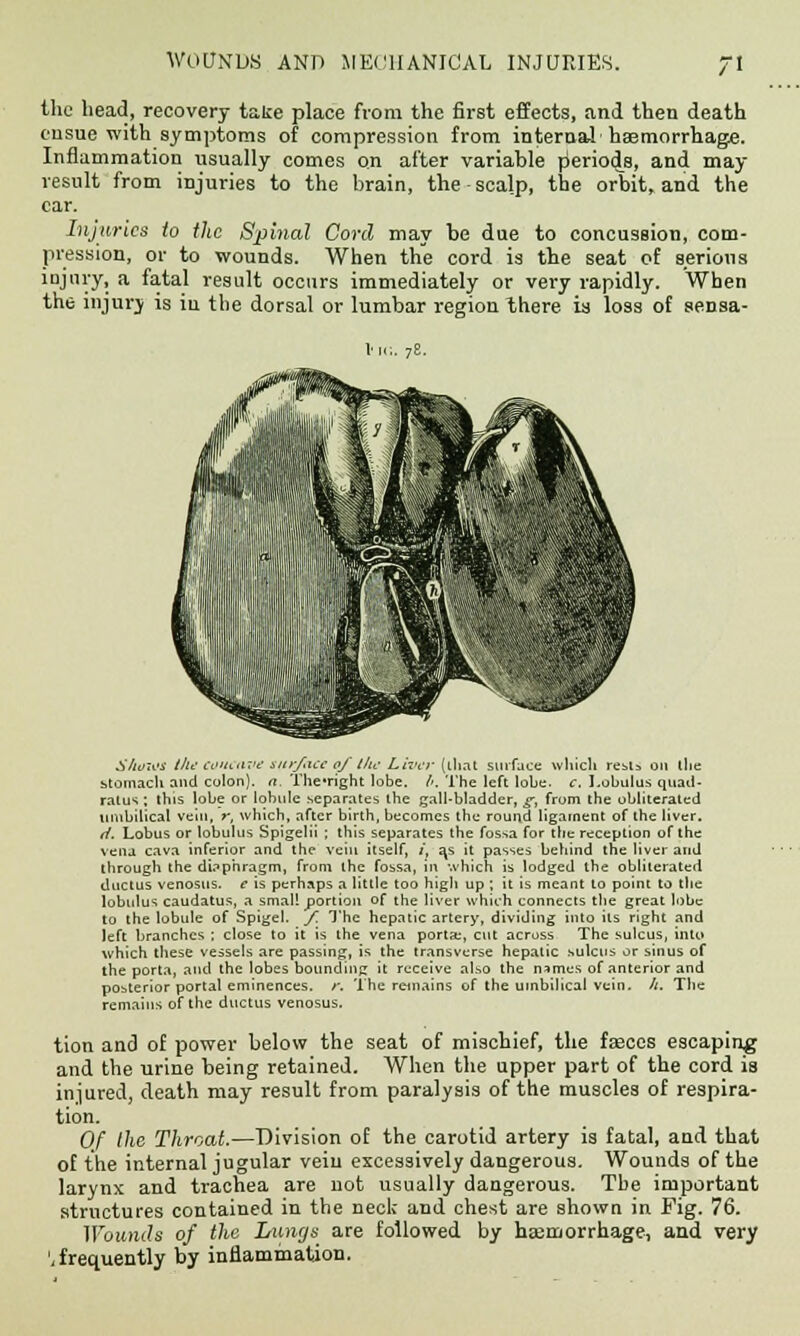 the head, recovery take place from the first effects, and then death ensue with symptoms of compression from internal haemorrhage. Inflammation usually comes on after variable periods, and may result from injuries to the brain, the scalp, the orbit, and the car. Injuries to the Spinal Corel may be due to concussion, com- pression, or to wounds. When the cord is the seat of serious injury, a fatal result occurs immediately or very rapidly. When the injury is in the dorsal or lumbar region there is loss of sensa- SAoios ille concave surface of l/w Liver (that surface which resu on the stomach and colon), a. The'right lobe. /'. The left lobe, c, I.obulu-s quad- ratic ; this lobe or lobule separates the gall-bladder, ^-, from the obliterated umbilical vein, r, which, after birth, becomes the round ligament of the liver. ti. Lobus or lobulus Spigelii ; this separates the fossa for the reception of the vena cava inferior and the vein itself, /, a,s it passes behind the liver and through the diaphragm, from the fossa, in which is lodged the obliterated ductus venosus. e is perhaps a little too high up ; it is meant to point to the lobulus caudatus, a small portion of the liver which connects the great lobe to the lobule of Spigel. f. The hepatic artery, dividing into its right and left branches : close to it is the vena porta, cut across The sulcus, into which these vessels are passing, is the transverse hepatic sulcus or sinus of the porta, and the lobes bounding it receive also the names of anterior and posterior portal eminences, r. The remains of the umbilical vein. /;. The remains of the ductus venosus. tion and of power below the seat of mischief, the feces escaping and the urine being retained. When the upper part of the cord is injured, death may result from paralysis of the muscles of respira- tion. Of the Throat.—Division of the carotid artery is fatal, and that of the internal jugular vein excessively dangerous. Wounds of the larynx and trachea are not usually dangerous. The important structures contained in the neck and chest are shown in Pig. 76. Wounds of the Lungs are followed by haemorrhage, and very ', frequently by inflammation.