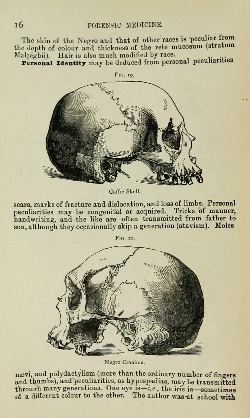 The akin of the Negro and that of other races is peculiar from the Jepth of colour and thickness of the rete mucosum (stratum Malpighii). Hair is also much modified by race. Personal Identity may be deduced from personal peculiarities Frc. 19. Caffre Skull. scars, marks of fracture and dislocation, and loss of limbs. Personal peculiarities may be congenital or acquired. Tricks of manner, handwriting, and the like are often transmitted from father to son, although they occasionally skip a generation (atavism). Moles Fig. Negro Cranium. n<evi, and polydactylism (more than the ordinary number of fingers and thumbs), and'peculiafities, as hypospadias, may be transmitted throush many generations. One eye is—i.e , the iris is—sometimea of a different colour to the other. The author was-at school with