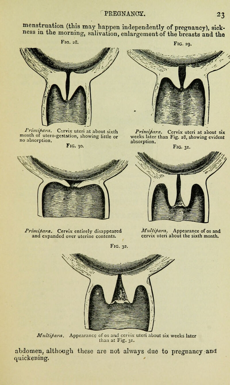 PREGNANOT. menstruation (this may happen independently of pregnancy), sick- ness in the morning, salivation, enlargement of the breasts and the Fig. 29. Fig. 28. I'nmipara. Ctrvix uteri at about sixth Primipara. Cervix uteri at about six month of utero-gestation, showing little or weeks later than Fig. 28, showing evident no absorption. absorption. Fig. 30. Fig. 31. Primipara. Cervix entirely disappeared and expanded over uterine contents. Fig. 32. Multipara. Appearance of os and cervix uteri about the sixth month. Multipara. Appearance of os and cervix uteri about six weeks later than at Fig. 31. abdomen, although these are not always due to pregnancy and quickening.