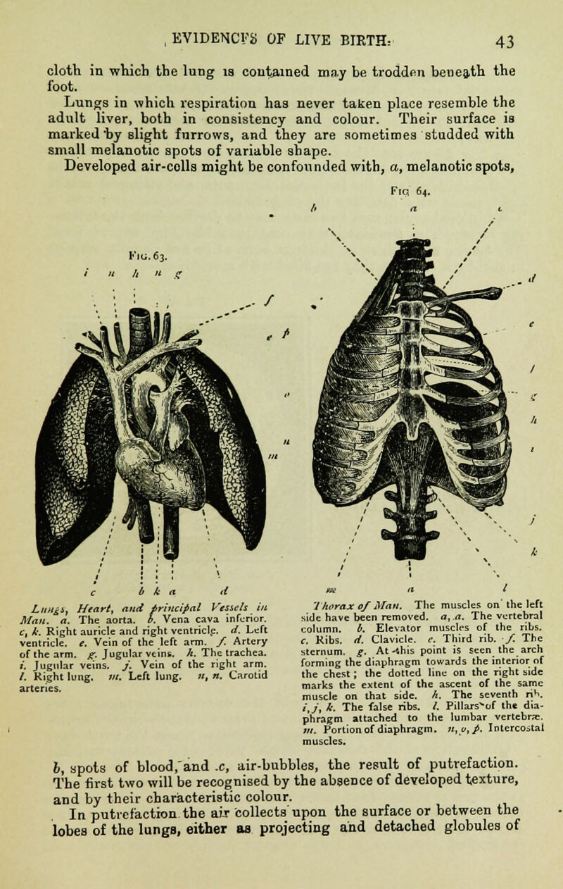 cloth in which the lung is contained may be trodden beueath the foot. Lungs in which respiration has never taken place resemble the adult liver, both in consistency and colour. Their surface is marked'by slight furrows, and they are sometimes studded with small melanotic spots of variable shape. Developed air-colls might be confounded with, a, melanotic spots, Fiq 64. Lnugi, Heart, and principal Vessels in Man. a. The aorta. I. Vena cava inferior. c, k. Right auricle and right ventricle, d. Left ventricle, e. Vein of the left arm. / Artery of the arm. R. Jugular veins, h. The trachea. i. Jugular veins. J. Vein of the right arm. /. Right lung. in. Left lung. n, n. Carotid arteries. Thorax 0/ Man. The muscles on' the left side have been removed, a, a. The vertebral column, b. Elevator muscles of the ribs. c. Ribs. d. Clavicle. <•. Third rib. ■/ The sternum, g. At -Shis point is seen_ the arch forming the diaphragm towards the interior of the chest; the dotted line on the right side marks the extent of the ascent of the same muscle on that side. h. The seventh rib. ij, i. The false ribs. /. Pillars-of the dia- phragm attached to the lumbar vertebra:. ;//. Portion of diaphragm. «,e,>. Intercostal muscles. b, spots of blood/and x, air-bubbles, the result of putrefaction. The first two will be recognised by the absence of developed texture, and by their characteristic colour. In putrefaction the air collects upon the surface or between the lobes of the lungs, either as projecting and detached globules of