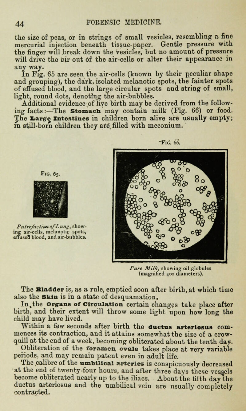 the size of peas, or in strings of small vesicles, resembling a fine mercurial injection beneath tissue-paper. Gentle pressure with the finger will break down the vesicles, but no amount of pressure will drive the air out of the air-cells or alter their appearance in any way. In Fig. 65 are seen the air-cells (known by their peculiar shape and grouping), the dark, isolated melanotic spots, the fainter spots of effused blood, and the large circular spots and string of small, light, round dots, denoting the air-bubbles. Additional evidence of live birth may be derived from the follow- ing facts:—The stomach may contain milk (Fig. 66) or food. The large intestines in children born alive are usually empty; in still-born children they are.filled with meconium.' Fig. 66. Fie. 6s. Putrefaction o/I.ung, show- ing air-cells, melanotic spots, efTuscfl blood, and air-bubbles. Fitrc Milk, showing oil globules (magnified 400 diameters). The Bladder is, as a rule, emptied soon after birth, at which time also the skin is in a state of desquamation. ln,the Organs of Circulation certain changes take place after birth, and their extent will throw some light upon how long the child may have lived. Within a few seconds after birth the ductus arteriosus com- mences its contraction, and it attains somewhat the size of a crow- quill at the end of a week, becoming obliterated about the tenth day. Obliteration of the foramen ovale takes place at very variable periods, and may remain patent even in adult life. The calibre of the umbilical arteries is conspicuously decreased at the end of twenty-four hours, and after three days these vessels become obliterated nearly up to the iliacs. About the filth day the ductus arteriosus and the umbilical vein are usually completely contracted.