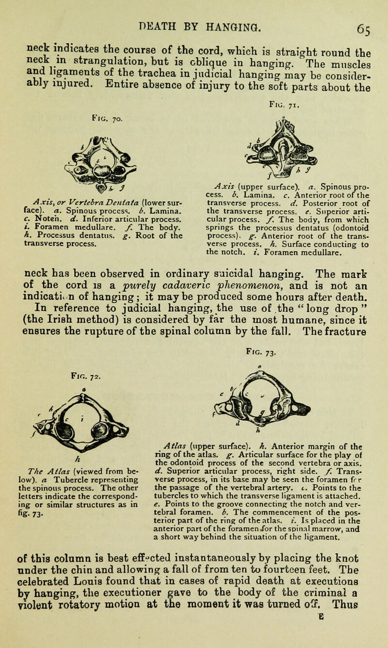 DEATH BY HANGING. neck indicates the course of the cord, which is straight round the neck m strangulation, but is oblique in hanging. The muscles and ligaments of the trachea injudicial hanging may be consider- ably injured. Entire absence of injury to the soft parts about the Fig. to. Axis, or Vertebra Dentata (lower sur- face), a. Spinous process, b. Lamina. c. Noteii. d. Inferior articular process. L Foramen medullare. f. The body. k. Processus dentatus. g. Root of the transverse process. Axis {upper surface), a. Spinous pro- cess, b. Lamina, c. Anterior root of the transverse process, d. Posterior root of the transverse process, e. Superior arti- cular process, f. The body, from which springs the processus dentatus (odontoid process), g. Anterior root of the trans- verse process, h. Surface conducting to the notch, i. Foramen medullare. neck has been observed in ordinary suicidal hanging. The mark of the cord is a purely cadaveric phenomenon, and is not an indication of hanging; it maybe produced some hours after death. In reference to judicial hanging, the use of the long drop (the Irish method) is considered by far the most humane, since it ensures the rupture of the spinal column by the fall. The fracture Fig. 73. Fin. 72. The Atlas (viewed from be- low), a Tubercle representing the spinous process. The other letters indicate the correspond- ing or similar structures as in fig- 73- m Atlas (upper surface), k. Anterior margin of the ring of the atlas. g~. Articular surface for the play of the odontoid process of the second vertebra or axis. d. Superior articular process, right side. f. Trans- verse process, in its base may be seen the foramen frr the passage of the vertebral artery, t. Points to the tubercles to which the transverse ligament is attached. e. Points to the groove connecting the notch and ver- tebral foramen, b. The commencement of the pos- terior part of the ring of the atlas, i. Is placed in the anterior part of the foramen .for the spinal marrow, and a short way behind the situation of the ligament. of this column is best effected instantaneously by placing the knot under the chin and allowing a fall of from ten to fourteen feet. The celebrated Louis found that in cases of rapid death at executions by hanging, the executioner gave to the body of the criminal a violent rotatory motion at the moment it was turned o<f. Thus