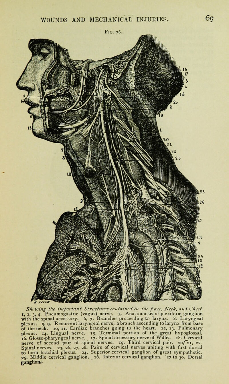 Fig. 76. 60 Shinving the important Structures contained in the Fact, NecA; ajtd Chsst 1,2,3,4. Pneumogastric (vagus) nerve. 5. Anastomosis of plexifuim ganglion with the spinal accessory. 6, 7. Branches proceeding to larynx. 8. Laryngeal plexus. 9, 9. Recurrent laryngeal nerve, a branch ascending to larynx from base of the neck. 10, 11. Cardiac branches going to the hoart. 12, 13. Pulmonary plexus. 14. Lingual nerve. 15. Terminal portion of the great hypoglossal. 16. Glossopharyngeal nerve. 17. Spinal accessory nerve of Willis. 18. Cervical nerve of second pair of spinal nerves. 19. Third cervical pair. 2o,'*2i, 22. Spinal nerves. 23, 26, 27, 28. Pairs of cervical nerves uniting with first dorsal to form brachial plexus. 24. Superior cervical ganglion of great sympathetic. 25. Middle cervical ganglion. 26. Inferior cervical ganglion. 27 to 30. Dorsal ganglion*-