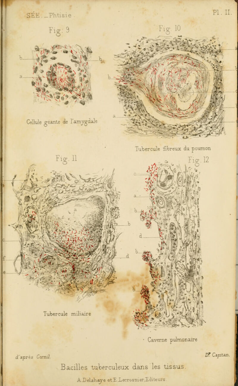 SEE ..Phtisie x: 9 PI. II. Fie; 10 Cellule géante de l'amygdale 3&1 *VÏ %a%* Fig. 11 Tubercule fibreux du poumon Fig. 12 M m Mm é /te ï&b b |A< •- gy a . #'■ • 'v. S Tubercule miliaire omil. «.%■- ' v -- - . ■ Caverne pulmonaire Bacilles tuberculeux dans les tissus. ADelahaye etE Lecro. : ~rs DT Capitan.