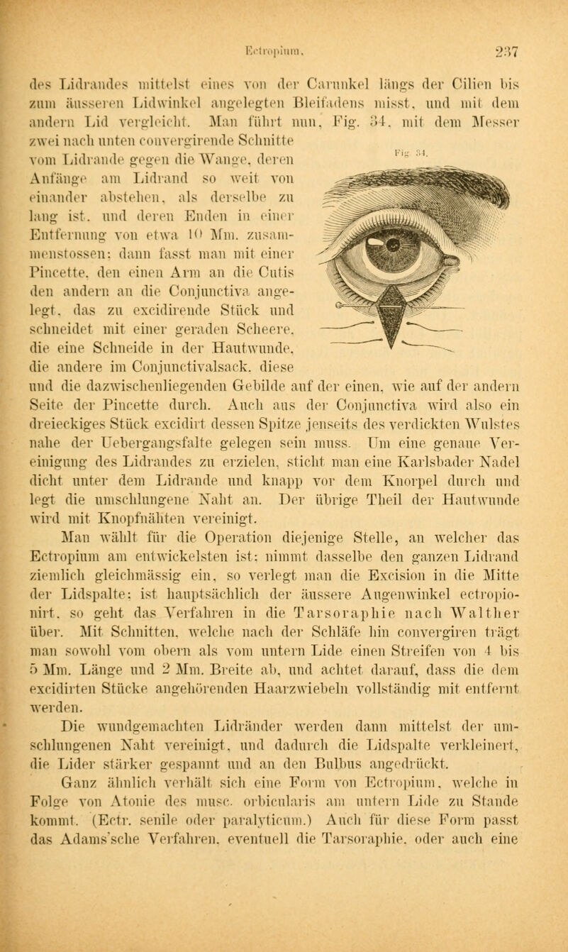 i : .•! des Lidrandes mittelsl eines von der Carankel längs der Cilien bis zum äusseren Lidwinke] angelegten Bleifadens misst, und mil dem andern Lid vergleicht. Man führt nun. Fig. 34, mit dem Messer ewei nach unten convergirende Schnitte vom Lidrande gegen die Wange, deren Anfänge am Lidrand so weit von einander abstehen, als derselbe zu lang ist. und deren Enden in einer Entfernung von etwa 10 Mm. zusam- menstossen; dann fasst man mit einer Pincette. den einen Arm an die Cutis den andern an die Conjunctiva ange- legt, das zu excidirende Stück und schneidet mit einer geraden Scheere, die eint1 Schneide in der Hautwunde, die andere im Conjunctivalsack, diese und die dazwischenliegenden Gebilde auf der einen, wie auf der andern Seite der Pincette durch. Auch aus der Conjunctiva wird also ein dreieckiges Stück excidirt dessen Spitze jenseits des verdickten Wulstes nahe der Uebergangsfalte gelegen sein muss. Um eine genaue Ver- einigung des Lidrandes zu erzielen, sticht man eine Karlsbader Nadel dicht unter dem Lidrande und knapp vor dem Knorpel durch und legt die umschlungene Naht an. Der übrige Theil der Hautwunde wird mit Knopfnähten vereinigt. Man wählt für die Operation diejenige Stelle, an welcher das Ectropium am entwickeisten ist: nimmt dasselbe den ganzen Lidrand ziemlich gleichmässig ein. so verlegt man die Excision in die Mitte der Lidspalte: ist hauptsächlich der äussere Augenwinkel ectropio- nirt. so geht das Verfahren in die Tarsoraphie nach Walt her über. Mit Schnitten, welche nach der Schläfe hin convergiren trägt man sowohl vom obern als vom untern Lide einen Streifen von l bis 5 Mm. Länge und 2 Mm. Breite ab. und achtet darauf, dass die dem excidirten Stücke angehörenden Haarzwiebeln vollständig mit entfernt werden. Die wundgemachten Lidränder werden dann mittelst der um- schlungenen Naht vereinigt, und dadurch die Lidspalte verkleinert, die Lider stärker gespannt und an den Bulbus angedrückt. Ganz ähnlich verhält sich eine Form von Ectropium, welche in Folge von A.tonie des musc. orbicularis am untern Lide zu Stande kommt. (Ecir. senile oder paralytictim.) Auch für diese Form passt das Adams'sche Verfahren, eventuell die Tarsoraphie. oder auch eine