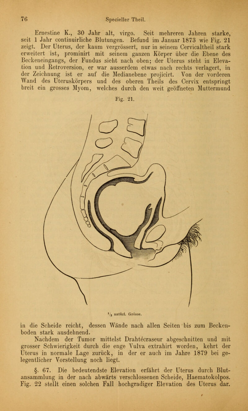 Ernestine K., 30 Jahr alt, virgo. Seit mehreren Jahren starke, seit 1 Jahr continuirliche Blutungen. Befund im Januar 1873 wie Fig. 21 zeigt. Der Uterus, der kaum vergrössert, nur in seinem Cervicaltheil stark erweitert ist, prominirt mit seinem ganzen Körper über die Ebene des Beckeneingangs, der Fundus sieht nach oben; der Uterus steht in Eleva- tion und Retroversion, er war ausserdem etwas nach rechts verlagert, in der Zeichnung ist er auf die Medianebene projicirt. Von der vorderen Wand des Uteruskörpers und des oberen TheiJs des Cervix entspringt breit ein grosses Myom, welches durch den weit geöffneten Muttermund Fig. 21. l/3 natürl. Grösse. in die Scheide reicht, dessen Wände nach allen Seiten bis zum Becken- boden stark ausdehnend. Nachdem der Tumor mittelst Drahtecraseur abgeschnitten und mit grosser Schwierigkeit durch die enge Vulva extrahirt worden, kehrt der Uterus in normale Lage zurück, in der er auch im Jahre 1879 bei ge- legentlicher Vorstellung noch liegt. §. 67. Die bedeutendste Elevation erfährt der Uterus durch Blut- ansammlung in der nach abwärts verschlossenen Scheide, Haematokolpos. Fig. 22 stellt einen solchen Fall hochgradiger Elevation des Uterus dar.
