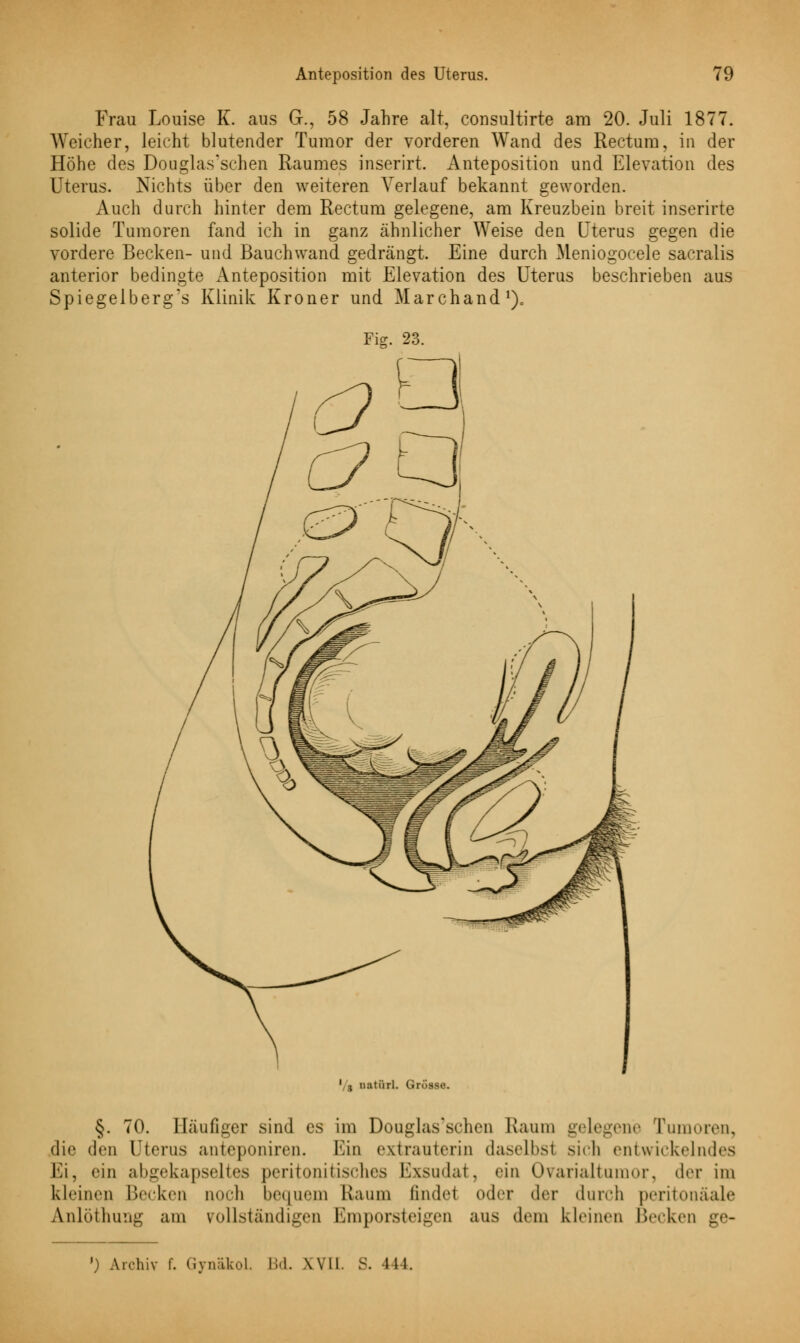 Frau Louise K. aus G., 58 Jahre alt, consultirte am 20. Juli 1877. Weicher, leicht blutender Tumor der vorderen Wand des Rectum, in der Höhe des Douglas'schen Raumes inserirt. Anteposition und Elevation des Uterus. Nichts über den weiteren Verlauf bekannt geworden. Auch durch hinter dem Rectum gelegene, am Kreuzbein breit inserirte solide Tumoren fand ich in ganz ähnlicher Weise den Uterus gegen die vordere Becken- und Bauch wand gedrängt. Eine durch Meniogocele sacralis anterior bedingte Anteposition mit Elevation des Uterus beschrieben aus Spiegelberg's Klinik Kroner und Marchand1),, 1 { lKitürl. Grösse. §. 70. Häufiger sind es im Douglas'schen Raum gelegene Tumoren, die den Uterus anteponiren. Ein extrauterin daselbsl sich entwickelndes Ei, ein abgekapseltes peritonitisches Exsudat, »'in Ovarialtumor, der im kleinen Becken noch bequem Kaum findet oder der durch peritoneale Anlöthung am vollständigen Emporsteigen aus dem kleinen Becken ge- ') Archiv f. Gynäkol. Bd. XVII. S. 444.