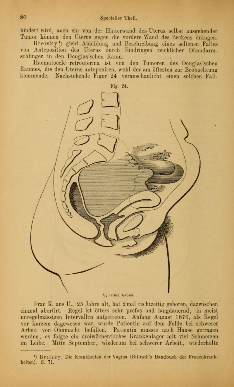 hindert wird, auch ein von der Hinlerwand des Uterus selbst ausgehender Tumor können den Uterus gegen die vordere Wand des Beckens drängen. Breisky1) giebt Abbildung und Beschreibung eines seltenen Falles von Anteposition des Uterus durch Eindringen reichlicher Dünndarm- schlingen in den Douglas'schen Raum. Haematocele retrouterina ist von den Tumoren des Douglas'schen Raumes, die den Uterus anteponiren, wohl der am öftesten zur Beobachtung kommende. Nachstehende Figur 24 veranschaulicht einen solchen Fall. Fig. 24. au •/a natürl. Grosse. Frau K. aus TL, 25 Jahre alt, hat 2 mal rechtzeitig geboren, dazwischen einmal abortirt. Regel ist öfters sehr profus und langdauernd, in meist unregelmassigen Intervallen aufgetreten. Anfang August 1876, als Regel vor kurzem dagewesen war, wurde Patientin auf dem Felde bei schwerer Arbeit von Ohnmacht befallen. Patientin musste nach Hause getragen werden, es folgte ein dreiwöchentliches Krankenlager mit viel Schmerzen im Leibe. Mitte September, wiederum bei schwerer Arbeit, wiederholte f) Breisky, Die Krankheiten der Vagina (Billroth's Handbuch der Frauenkrank- heiten). S. 71.