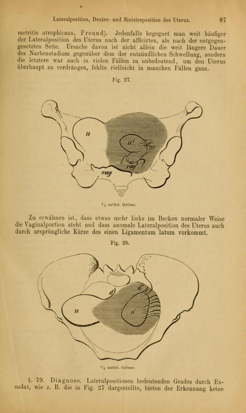 metritis atrophicans, Freund). Jedenfalls begegnet man weit häufiger der Lateralposition des Uterus nach der afficirten, als nach der entgegen- gesetzten Seite. Ursache davon ist nicht allein die weit längere Dauer des Narbenstadium gegenüber dem der entzündlichen Schwellung, sondern die letztere war auch in vielen Fällen zu unbedeutend, um den Uterus überhaupt zu verdrängen, fehlte vielleicht in manchen Fällen ganz. Fig. 27. 1 3 natürl. Grösse. Zu erwähnen ist, dass etwas mehr links im Becken normaler Weise die Vaginalportion steht und dass anomale Lateralposition des Uterus auch durch ursprüngliche Kürze des einen Ligamentum latum vorkommt. Fig. 28. 1 | natöri. Grösse. §. 7(.). Diagnose. Lateralpositionen bedeutenden Grades durch Ex- sudat, wie z. B. die in Fig. 27 dargestellte, bieten der Erkennung keine