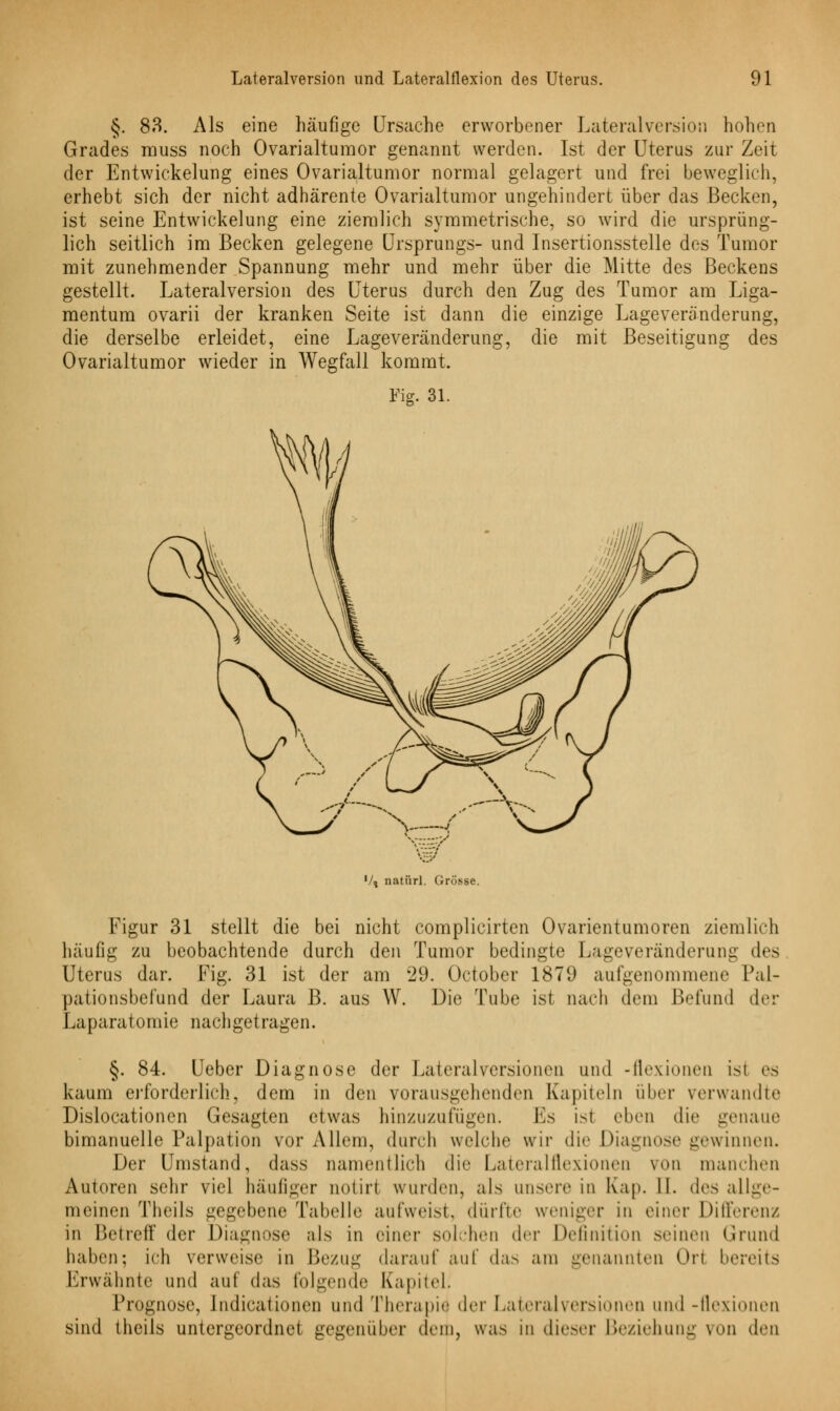 §. 83. Als eine häufige Ursache erworbener Lateralversion hohen Grades rnuss noch Ovarialtumor genannt werden. Ist der Uterus zur Zeit der Entwicklung eines Ovarialtumor normal gelagert und frei beweglich, erhebt sich der nicht adhärente Ovarialtumor ungehindert über das Becken, ist seine Entwicklung eine ziemlich symmetrische, so wird die ursprüng- lich seitlich im Becken gelegene Ursprungs- und Insertionsstelle des Tumor mit zunehmender Spannung mehr und mehr über die Mitte des Beckens gestellt. Lateralversion des Uterus durch den Zug des Tumor am Liga- mentum ovarii der kranken Seite ist dann die einzige Lageveränderung, die derselbe erleidet, eine Lage Veränderung, die mit Beseitigung des Ovarialtumor wieder in Wegfall kommt. Fig. 31. Vt natürl. Grösse. Figur 31 stellt die bei nicht complicirten Ovarialtumoren ziemlich häufig zu beobachtende durch den Tumor bedingte Lageveränderung des Uterus dar. Fig. 31 ist der am 29. Octobcr 1879 aufgenommene Pal- pationsbelünd der Laura B. aus W. Die Tube ist nach dein Befund der Laparatomie nachgetragen. §. 84. Ueber Diagnose der Lateralversionen und -flexionen ist es kaum erforderlich, dem in den vorausgehenden Kapiteln über verwandte Dislocationen Gesagten etwas hinzuzufügen. Es ist eben die genaue bimanuelle Palpation vor Allem, durch welche wir die Diagnose gewinnen. Der Umstand, dass namentlich die Lateralflexionen von manchen Autoren sehr viel häufiger imtirt wurden, als unsere in Kap. 11. des allge- meinen Theils gegebene Tabelle aufweist, durfte weniger in einer Differenz in Betreff der Diagnose als in einer solchen der Definition seinen Grund haben; ich verweise in Bezug darauf auf das am genannten Ort bereits Erwähnte und auf das folgende Kapitel. Prognose, Indurationen und Therapiä der Lateralversionen und -flexionen sind theils untergeordnet gegenüber dem, was in dieser Beziehung von den