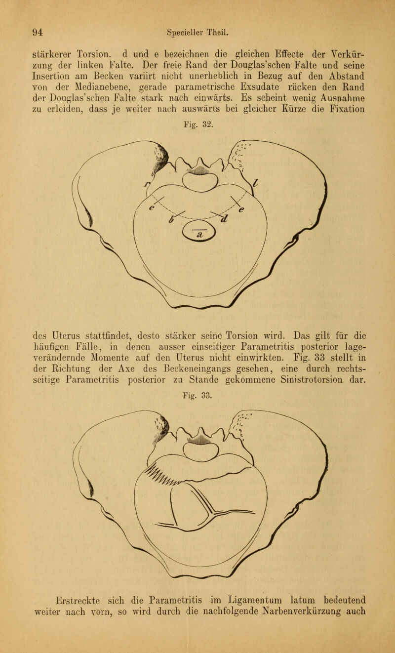 stärkerer Torsion, d und e bezeichnen die gleichen Effecte der Verkür- zung der linken Falte. Der freie Rand der Douglas'schen Falte und seine Insertion am Becken variirt nicht unerheblich in Bezug auf den Abstand von der Medianebene, gerade parametrische Exsudate rücken den Rand der Douglas'schen Falte stark nach einwärts. Es scheint wenig Ausnahme zu erleiden, dass je weiter nach auswärts bei gleicher Kürze die Fixation Fig. 32. des Uterus stattfindet, desto stärker seine Torsion wird. Das gilt für die häufigen Fälle, in denen ausser einseitiger Parametritis posterior lage- verändernde Momente auf den Uterus nicht einwirkten. Fig. 33 stellt in der Richtung der Axe des Beckeneingangs gesehen, eine durch rechts- seitige Parametritis posterior zu Stande gekommene Sinistrotorsion dar. Fig. 33. Erstreckte sich die Parametritis im Ligamentum latum bedeutend weiter nach vorn, so wird durch die nachfolgende Narbenverkürzung auch