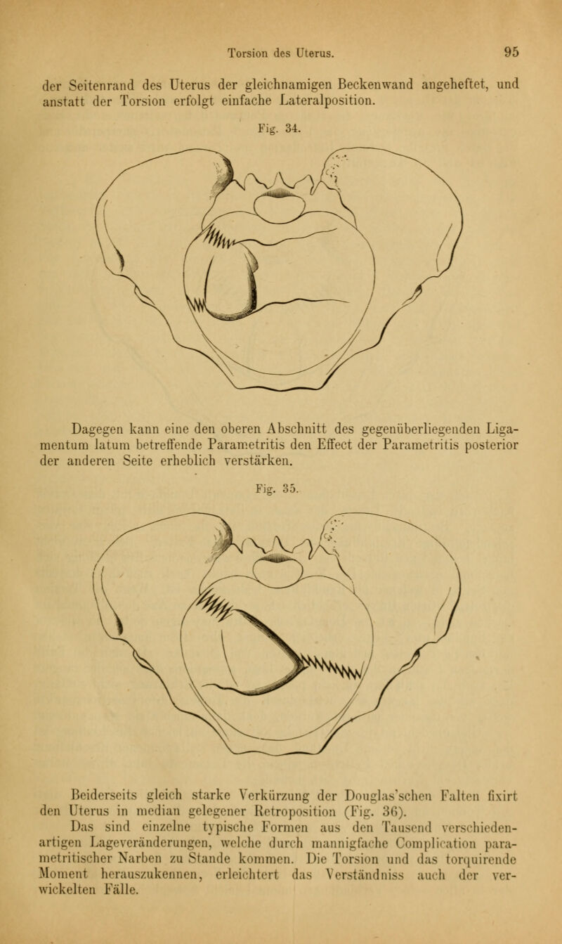 der Seitenrand des Uterus der gleichnamigen Beckenwand angeheftet, und anstatt der Torsion erfolgt einfache Lateralposition. Fig. 34. Dagegen kann eine den oberen Abschnitt des gegenüberliegenden Liga- mentum latum betreffende Parametritis den Effect der Parametritis posterior der anderen Seite erheblich verstärken. Fig. 35. Beiderseits gleich starke Verkürzung der Douglas'schen Palten fixirl den Uterus in median gelegener Etetroposition (Fig. 36). Das sind einzelne typische Formen aus den Tausend verschieden- artigen Lageveränderungen, welche durch mannigfache Complication para- metritischer Narben zu Stande kommen. Die Torsion und das torquirende Moment herauszukönnen, erleichtert das V erstand niss auch der ver- wickelten Fälle.