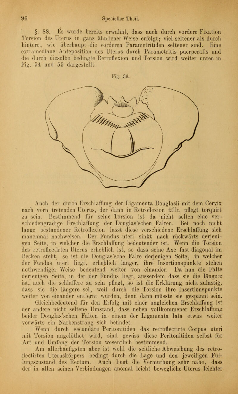 §. 88. Es wurde bereits erwähnt, dass auch durch vordere Fixation Torsion des Uterus in ganz ähnlicher Weise erfolgt; viel seltener als durch hintere, wie überhaupt die vorderen Parametritiden seltener sind. Eine extramediane Anteposition des Uterus durch Pararaetritis puerperalis und. die durch dieselbe bedingte Retroflexion und Torsion wird weiter unten in Fig. 54 und 55 dargestellt. Fig. .36. Auch der durch Erschlaffung der Ligamenta Douglasii mit dem Cervix nach vorn tretenden Uterus, der dann in Retroflexion fällt, pflegt torquirt zu sein. Bestimmend für seine Torsion ist da nicht selten eine ver- schiedengradige Erschlaffung der Douglas'schen Falten. Bei noch nicht lange bestandener Retroflexion lässt diese verschiedene Erschlaffung sich manchmal nachweisen. Der Fundus uteri sinkt nach rückwärts derjeni- gen Seite, in welcher die Erschlaffung bedeutender ist. Wenn die Torsion des retroflectirten Uterus erheblich ist, so dass seine Axe fast diagonal im Becken steht, so ist die Douglas'sche Falte derjenigen Seite, in welcher der Fundus uteri liegt, erheblich länger, ihre Insertionspunkte stehen nothwendiger Weise bedeutend weiter von einander. Da nun die Falte derjenigen Seite, in der der Fundus liegt, ausserdem dass sie die längere ist, auch die schlaffere zu sein pflegt, so ist die Erklärung nicht zulässig, dass sie die längere sei, weil durch die Torsion ihre Insertionspunkte weiter von einander entfernt wurden, denn dann müsste sie gespannt sein. Gleichbedeutend für den Erfolg mit einer ungleichen Erschlaffung ist der andere nicht seltene Umstand, dass neben vollkommener Erschlaffung beider Douglas'schen Falten in einem der Ligamenta lata etwas weiter vorwärts ein Narbenstrang sich befindet. Wenn durch secundäre Peritonitiden das retroflectirte Corpus uteri mit Torsion angelöthet wird, sind gewiss diese Peritonitiden selbst für Art und Umfang der Torsion wesentlich bestimmend. Am allerhäufigsten aber ist wohl die seitliche Abweichung des retro- flectirten Uteruskörpers bedingt durch die Lage und den jeweiligen Fül- lungszustand des Rectum. Auch liegt die Vermuthung sehr nahe, dass der in allen seinen Verbindungen anomal leicht bewegliche Uterus leichter