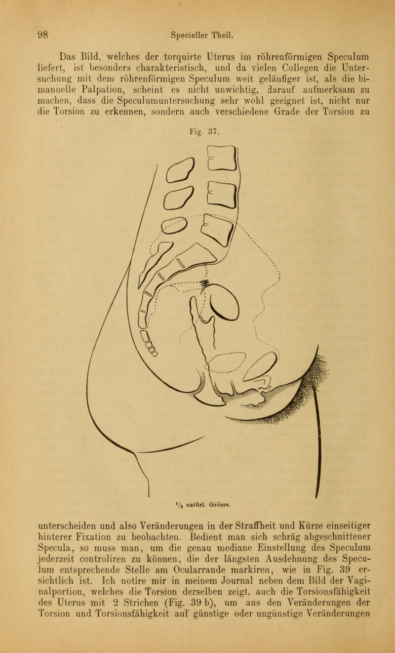 Das Bild, welches der torquirte Uterus im röhrenförmigen Speculum liefert, ist besonders charakteristisch, und da vielen Collegen die Unter- suchung mit dem röhrenförmigen Speculum weit geläufiger ist, als die bi- manuelle Palpation, scheint es nicht unwichtig, darauf aufmerksam zu machen, dass die Speculumuntersuchung sehr wohl geeignet ist, nicht nur die Torsion zu erkennen, sondern auch verschiedene Grade der Torsion zu Fig. 37. '/j natürl. Grosse. unterscheiden und also Veränderungen in der Straffheit und Kürze einseitiger hinterer Fixation zu beobachten. Bedient man sich schräg abgeschnittener Specula, so muss man, um die genau mediane Einstellung des Speculum jederzeit controliren zu können, die der längsten Ausdehnung des Specu- lum entsprechende Stelle am Ocularrande markiren, wie in Fig. 39 er- sichtlich ist. Ich notire mir in meinem Journal neben dem Bild der Vagi- nalportion, welches die Torsion derselben zeigt, auch die Torsionsfähigkeit des Uterus mit 2 Strichen (Fig. 39 b), um aus den Veränderungen der Torsion und Torsionsfähigkeit auf günstige oder ungünstige Veränderungen