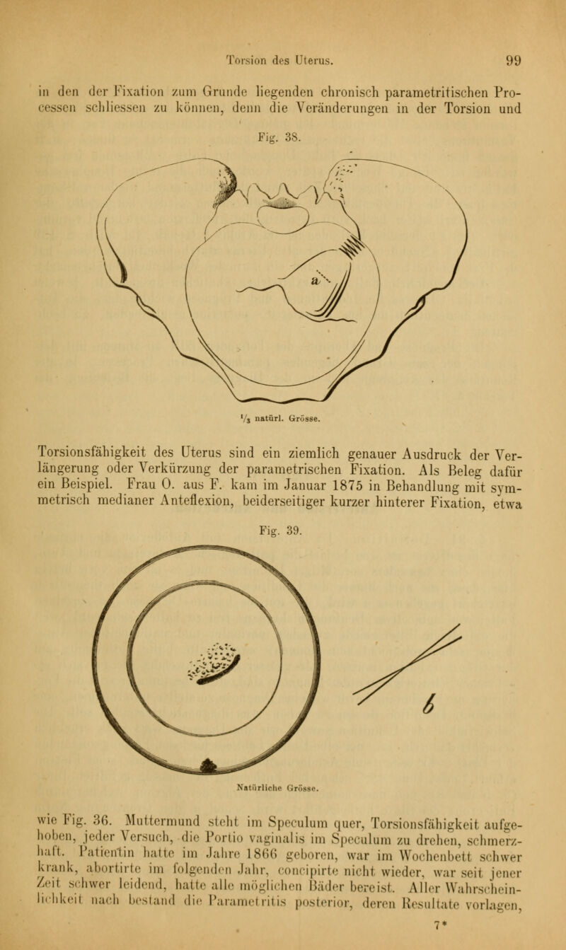 in den der Fixation zum Grunde liegenden chronisch parametritischen Pro- ben schliessen zu können, denn die Veränderungen in der Torsion und Fig. 38. V3 natürl. Grösse. Torsionsfähigkeit des Uterus sind ein ziemlich genauer Ausdruck der Ver- längerung oder Verkürzung der parametrischen Fixation. Als Beleg dafür ein Beispiel. Frau 0. aus F. kam im Januar 1875 in Behandlung mit sym- metrisch medianer Anteflexion, beiderseitiger kurzer hinterer Fixation, etwa Fig. 39. Natiirlirlii' i.r..--.-. wie Fig. 36. Muttermund stehi im Speculum quer, Toreionsföhigkeil aufge- hoben, jeder Versuch, die Portio vaginalis im Speculum zu drehen, schmerz- haft. Patientin hatte im Jahre L866 geboren, war im Wochenbett schwer krank, abortirte im folgenden Jahr, concipirte nichl wieder, war seil jener Zeil schwer leidend, hatte alle möglichen Bäder bereist. Aller Wahrschein- lichkeH nach bestand die Parametritis posterior, deren Resultate vorlagen 7*