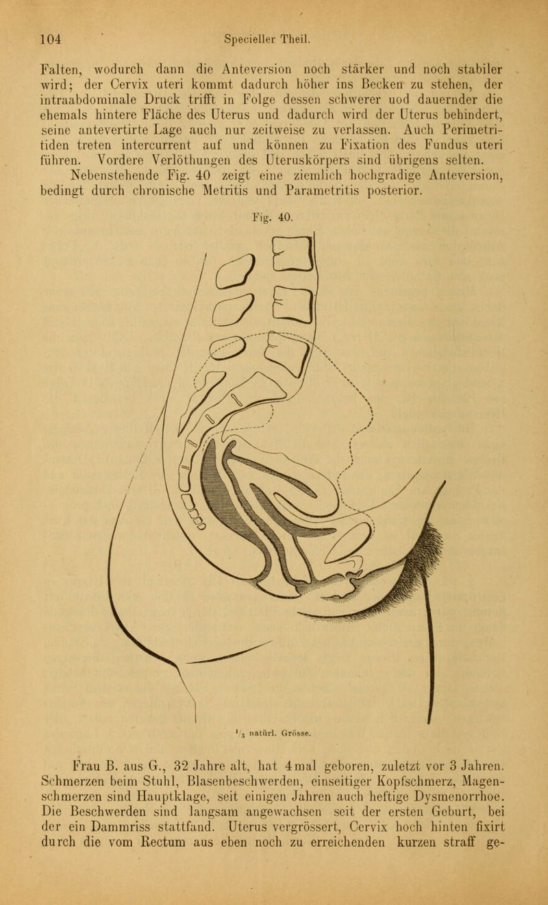 Falten, wodurch dann die Anteversion noch stärker und noch stabiler wird; der Cervix uteri kommt dadurch höher ins Becken zu stehen, der intraabdominale Druck trifft in Folge dessen schwerer uod dauernder die ehemals hintere Fläche des Uterus und dadurch wird der Uterus behindert, seine antevertirte Lage auch nur zeitweise zu verlassen. Auch Perimetri- tiden treten intercurrent auf und können zu Fixation des Fundus uteri führen. Vordere Verlöthungen des Uteruskörpers sind übrigens selten. Nebenstehende Fig. 40 zeigt eine ziemlich hochgradige Anteversion, bedingt durch chronische Metritis und Parametritis posterior. Fig. 40. 1 3 natürl. Grösse. Frau B. aus G., 32 Jahre alt, hat 4mal geboren, zuletzt vor 3 Jahren. Schmerzen beim Stuhl, Blasenbeschwerden, einseitiger Kopfschmerz, Magen- schmerzen sind Hauptklage, seit einigen Jahren auch heftige Dysmenorrhoe. Die Beschwerden sind langsam angewachsen seit der ersten Geburt, bei der ein Dammriss stattfand. Uterus vergrössert, Cervix hoch hinten fixirt durch die vom Rectum aus eben noch zu erreichenden kurzen straff ge-
