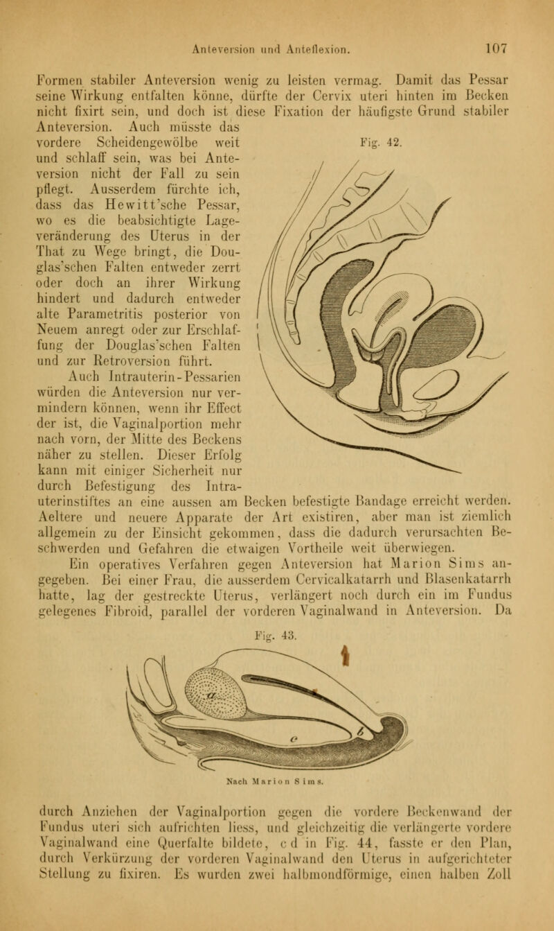 Fig. 42. Formen stabiler Anteversion wenig zu leisten vermag. Damit das Pessar seine Wirkung entfalten könne, dürfte der Cervix uteri hinten im Becken nicht fixirt sein, und doch ist diese Fixation der häufigste Grund stabiler Anteversion. Auch müsste das vordere Scheidengewölbe weit und schlaff sein, was bei Ante- version nicht der Fall zu sein pflegt. Ausserdem fürchte ich, dass das Hewitt'sche Pessar, wo es die beabsichtigte Lage- veränderung des Uterus in der That zu Wege bringt, die Dou- glas'schen Falten entweder zerrt oder doch an ihrer Wirkung hindert und dadurch entweder alte Parametritis posterior von Neuem anregt oder zur Erschlaf- fung der Douglas'schen Falten und zur Retroversion führt. A ach Intrauterin-Pessarien würden die Anteversion nur ver- mindern können, wenn ihr Effect der ist, die Vaginalportion mehr nach vorn, der Mitte des Beckens näher zu stellen. Dieser Erfolg kann mit einiger Sicherheit nur durch Befestigung des Intra- uterinstiftes an eine aussen am Becken befestigte Bandage erreicht werden. Aeltere und neuere Apparate der Art existiren, aber man ist ziemlich allgemein zu der Einsicht gekommen, dass die dadurch verursachten Be- schwerden und Gefahren die etwaigen Vortheile weit überwiegen. Ein operatives Verfahren gegen Anteversion hat Marion Sims an- gegeben. Bei einer Frau, die ausserdem Cervicalkatarrh und Blasenkatarrh hatte, lag der gestreckte Uterus, verlängert noch durch ein im Fundus gelegenes Fibroid, parallel der vorderen Vaginalwand in Anteversion. Da Fig. 43. Nach M fi r i <> n S i in B. durch Anziehen der Vaginalportion gegen die vordere Beckenwand der Kundus uteri sich aufrichten liess, und gleichzeitig die verlängerte vordere Vaginalwand eine Querfalte bildete, cd in Fig. 1-1. fasste er den Hau, durch Verkürzung der vorderen Vaginalwand den Uterus in aufgerichteter Stellung zu fixiren. Es wurden zwei halbmondförmige, einen halben Zoll