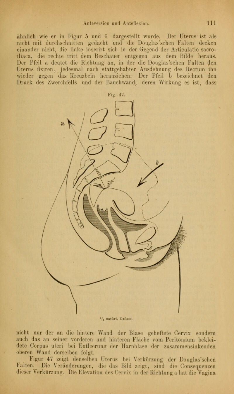 ähnlich wie er in Figur 5 und G dargestellt wurde. Der Uterus ist als nicht mit durchschnitten gedacht und die Douglas'schen Falten decken einander nicht, die linke inserirt sich in der Gegend der Articulatio sacro- iliaca, die rechte tritt dem Beschauer entgegen aus dem Bilde heraus. Der Pfeil a deutet die Richtung an, in der die Douglas'schen Falten den Uterus fixiren, jedesmal nach stattgehabter Ausdehnung des Rectum ihn wieder gegen das Kreuzbein heranziehen. Der Pfeil b bezeichnet den Druck des Zwerchfells und der Bauchwand, deren Wirkung es ist, dass Fig. 47. Vj natürl. Gr nicht nur der an die hinter.' Wand der Ulase -.'heftete Cervix sondern auch das an seiner vorderen und hinteren Fläche vom Peritonäum beklei- dete Corpus uteri bei Entleerung «In- Barnblase der zusammensinkenden oberen Wand derselben folgt. Figur 47 zeigl denselben Uterus bei Verkürzung der Douglas'schen Falten. Die Veränderungen, die das Bild zeigt, sind die Consequenzen dieser Verkürzung. Die Elevation des Cervix in derRichtunga hat die Vagina