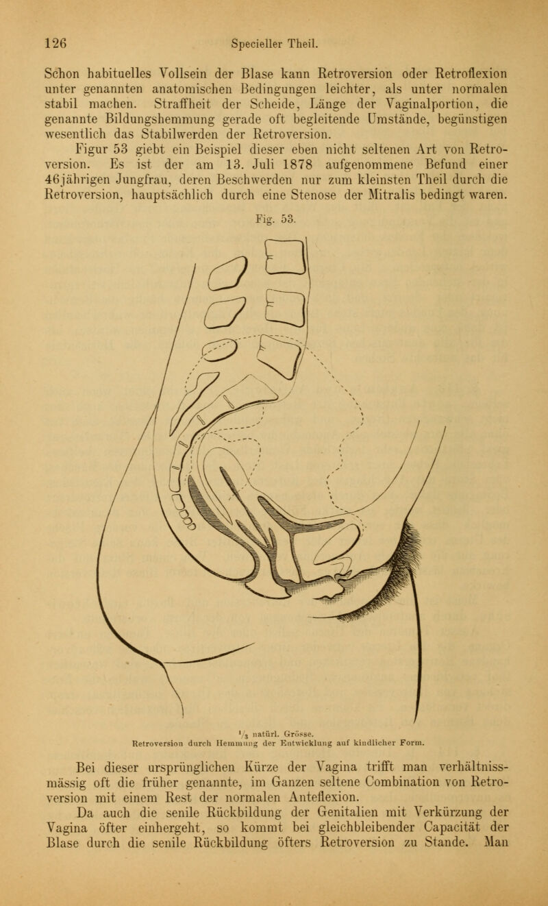 Schon habituelles Vollsein der Blase kann Retroversion oder Retroflexion unter genannten anatomischen Bedingungen leichter, als unter normalen stabil machen. Straffheit der Scheide, Länge der Vaginalportion, die genannte Bildungshemmung gerade oft begleitende Umstände, begünstigen wesentlich das Stabil werden der Retroversion. Figur 53 giebt ein Beispiel dieser eben nicht seltenen Art von Retro- version. Es ist der am 13. Juli 1878 aufgenommene Befund einer 46jährigen Jungfrau, deren Beschwerden nur zum kleinsten Theil durch die Retroversion, hauptsächlich durch eine Stenose der Mitralis bedingt waren. Fig. 53. 1 3 natürl. Grösse. Retroversion durch Hemmung der Entwicklung auf kindlicher Form. Bei dieser ursprünglichen Kürze der Vagina trifft man verhältniss- mässig oft die früher genannte, im Ganzen seltene Combination von Retro- version mit einem Rest der normalen Anteflexion. Da auch die senile Rückbildung der Genitalien mit Verkürzung der Vagina öfter einhergeht, so kommt bei gleichbleibender Capacität der Blase durch die senile Rückbilduno: öfters Retroversion zu Stande. Man