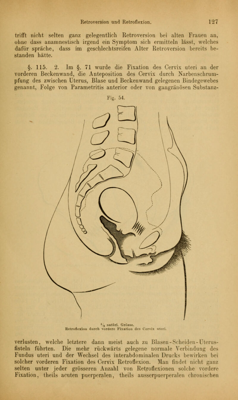 trifft nicht selten ganz gelegentlich Retroversion bei alten Frauen an, ohne dass anamnestisch irgend ein Symptom sich ermitteln lässt, welches dafür spräche, dass im geschlechtsreifen Alter Retroversion bereits be- standen hätte. §. 115. 2. Im §. 71 wurde die Fixation des Cervix uteri an der vorderen Beckenwand, die Anteposition des Cervix durch Narbenschrum- pfung des zwischen Uterus, Blase und Beckenwand gelegenen Bindegewebes genannt, Folge von Parametritis anterior oder von gangränösen Substanz- Fig. 54. 1 j natürl. Grösse. Retroflexion durch vordere Fixation des CVrvix uteri. Verlusten, welche letztere dann meist auch zu Blasen-Scheiden-Uterus- fisteln führten. Die mehr rückwärts gelegene normale Verbindung des Fundus uteri und der Wechsel des interabdominalen Drucks bewirken bei solcher vorderen Fixation des Cervix RetroüVxion. Mau finde! nichl ganz selten unter jeder grösseren Anzahl von Retroflexionen solche vordere Fixation, theils acuten puerperalen, theils ausserpuerperalen chronischen