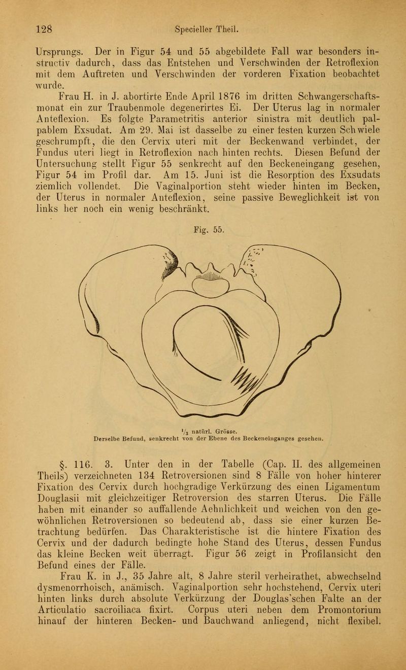 Ursprungs. Der in Figur 54 und 55 abgebildete Fall war besonders in- struetiv dadurch, dass das Entstehen und Verschwinden der Retroflexion mit dem Auftreten und Verschwinden der vorderen Fixation beobachtet wurde. Frau H. in J. abortirte Ende April 1876 im dritten Schwangerschafts- monat ein zur Traubenmole degenerirtes Ei. Der Uterus lag in normaler Anteflexion. Es folgte Parametritis anterior sinistra mit deutlich pal- pablem Exsudat. Am 29. Mai ist dasselbe zu einer testen kurzen Schwiele geschrumpft, die den Cervix uteri mit der Beckenwand verbindet, der Fundus uteri liegt in Retroüexion nach hinten rechts. Diesen Befund der Untersuchung stellt Figur 55 senkrecht auf den Beckeneingang gesehen, Figur 54 im Profil dar. Am 15. Juni ist die Resorption des Exsudats ziemlich vollendet. Die Vaginalportion steht wieder hinten im Becken, der Uterus in normaler Anteflexion, seine passive Beweglichkeit ist von links her noch ein wenig beschränkt. Fig. 55. '/3 natürl. Grösse. Derselbe Befund, senkrecht von der Ebene des Beckeneinganges gesehen. §. 116. 3. Unter den in der Tabelle (Cap. II. des allgemeinen Theils) verzeichneten 134 Retroversionen sind 8 Fälle von hoher hinterer Fixation des Cervix durch hochgradige Verkürzung des einen Ligamentum Douglasii mit gleichzeitiger Retroversion des starren Uterus. Die Fälle haben mit einander so auffallende Aehnlichkeit und weichen von den ge- wöhnlichen Retroversionen so bedeutend ab, dass sie einer kurzen Be- trachtung bedürfen. Das Charakteristische ist die hintere Fixation des Cervix und der dadurch bedingte hohe Stand des Uterus, dessen Fundus das kleine Becken weit überragt. Figur 56 zeigt in Profilansicht den Befund eines der Fälle. Frau K. in J., 35 Jahre alt, 8 Jahre steril verheirathet, abwechselnd dysmenorrhoisch, anämisch. Vaginalportion sehr hochstehend, Cervix uteri hinten links durch absolute Verkürzung der Douglas'schen Falte an der Articulatio sacroiliaca fixirt. Corpus uteri neben dem Promontorium hinauf der hinteren Becken- und Bauch wand anliegend, nicht flexibel.