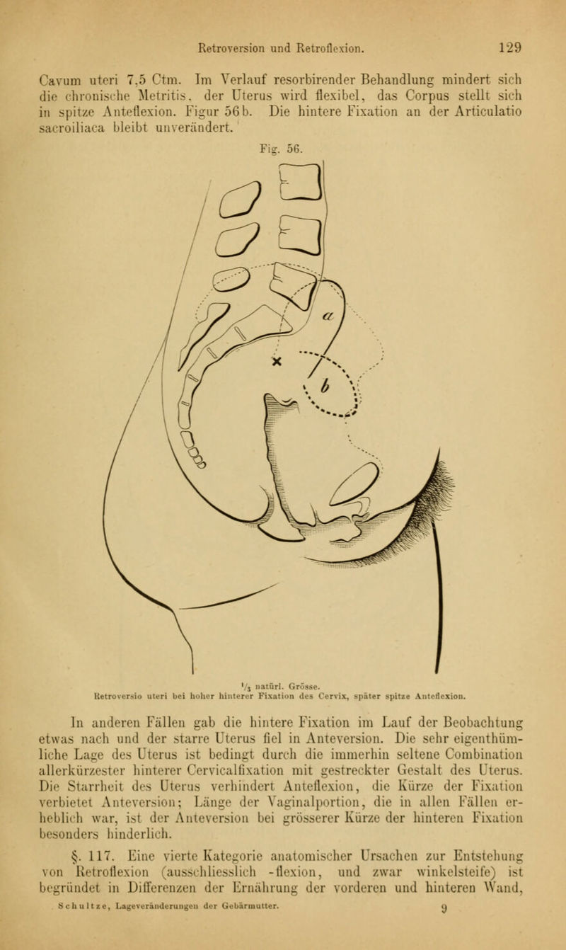 Oavum uteri 7.5 Ctm. Im Verlauf resorbirender Behandlung mindert sich die chronische Metritis, der Uterus wird flexibel, das Corpus stellt sich in spitze Anteflexion. Figur 56 b. Die hintere Fixation an der Articulatio sacroiliaca bleibt unverändert. Fig. 56. '/j natürl. Grösse. Ketroversio uteri bei hoher hinterer Fixation des Cervix, später spitze Antetlexiou. In anderen Fällen gah die hintere Fixation im Lauf der Beobachtung etwas nach und der starre Uterus fiel in Anteversion. Die sehr eigentüm- liche Lage des Uterus ist bedingt durch die immerhin seltene Combination allerkürzester hinterer Cervicalfixation mit gestreckter Gestall des Uterus. Die Starrheit des Uterus verhindert Anteflexion, die Kürze der Fixation verbiete! Anteversion; Lange der Vaginalportion, die in allen Fällen er- heblich war, isl der Anteversion bei grösserer Kürze der hinteren Fixation besonders hinderlich. §. 117. Eine vierte Kategorie anatomischer Ursachen zur Entstehung von Retroflexion ausschliesslich -flexion, und /war winkelsteife) isl begründet in Differenzen der Ernährung der vorderen und hinteren Wand. Sehultie, Legeverinderungen der Gebärmutter. u