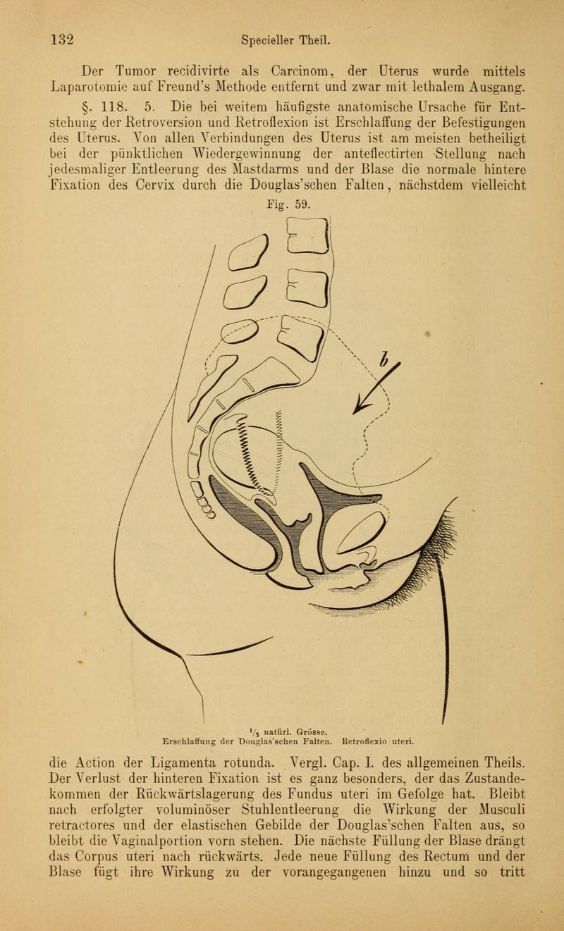 Der Tumor recidivirte als Carcinom, der Uterus wurde mittels Laparotomie auf Freund's Methode entfernt und zwar mit lethalem Ausgang. §. 118. 5. Die bei weitem häufigste anatomische Ursache für Ent- stehung der Retroversion und Retroflexion ist Erschlaffung der Befestigungen des Uterus. Von allen Verbindungen des Uterus ist am meisten betheiligt bei der pünktlichen Wiedergewinnung der anteneetirten Stellung nach jedesmaliger Entleerung des Mastdarms und der Blase die normale hintere Fixation des Cervix durch die Douglas'schen Falten, nächstdem vielleicht Fig. 59. Vs natürl. Grösse. Erschlaffung der Douglas'schen Falten. Retroflexio uteri. die Action der Ligamenta rotunda. Vergl. Cap. I. des allgemeinen Theils. Der Verlust der hinteren Fixation ist es ganz besonders, der das Zustande- kommen der Rückwärtslagerung des Fundus uteri im Gefolge hat. Bleibt nach erfolgter voluminöser Stuhlentleerung die Wirkung der Musculi retractores und der elastischen Gebilde der Douglas'schen Falten aus, so bleibt die Vaginalportion vorn stehen. Die nächste Füllung der Blase drängt das Corpus uteri nach rückwärts. Jede neue Füllung des Rectum und der Blase fügt ihre Wirkung zu der vorangegangenen hinzu und so tritt