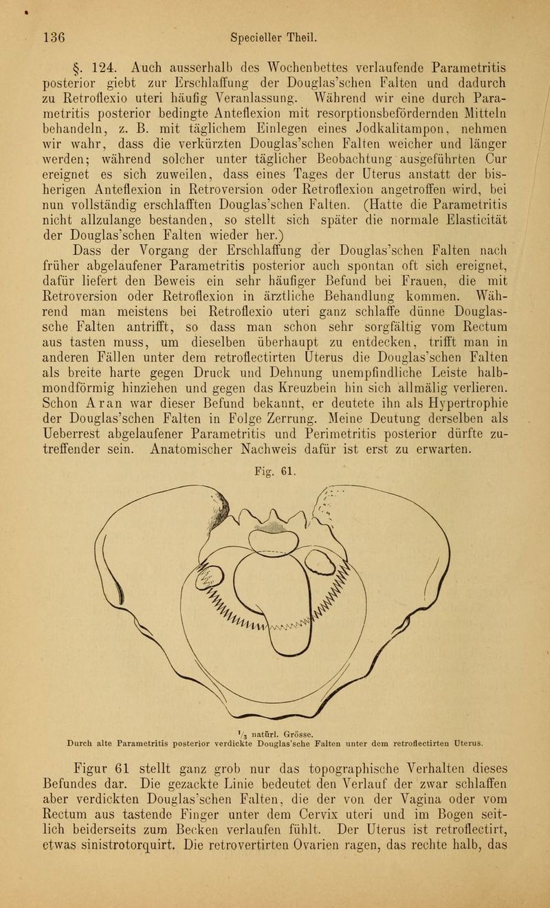 §. 124. Auch ausserhalb des Wochenbettes verlaufende Parametritis posterior giebt zur Erschlaffung der Douglas'scheu Falten und dadurch zu Retroflexio uteri häufig Veranlassung. Während wir eine durch Para- metritis posterior bedingte Anteflexion mit resorptionsbefördernden Mitteln behandeln, z. B. mit täglichem Einlegen eines Jodkalitampon, nehmen wir wahr, dass die verkürzten Douglas'schen Falten weicher und länger werden; während solcher unter täglicher Beobachtung ausgeführten Cur ereignet es sich zuweilen, dass eines Tages der Uterus anstatt der bis- herigen Anteflexion in Retroversion oder Retroflexion angetroffen wird, bei nun vollständig erschlafften Douglas'schen Falten. (Hatte die Parametritis nicht allzulange bestanden, so stellt sich später die normale Elasticität der Douglas'schen Falten wieder her.) Dass der Vorgang der Erschlaffung der Douglas'schen Falten nach früher abgelaufener Parametritis posterior auch spontan oft sich ereignet, dafür liefert den Beweis ein sehr häufiger Befund bei Frauen, die mit Retroversion oder Retroflexion in ärztliche Behandlung kommen. Wäh- rend man meistens bei Retroflexio uteri ganz schlaffe dünne Douglas- sche Falten antrifft, so dass man schon sehr sorgfältig vom Rectum aus tasten muss, um dieselben überhaupt zu entdecken, trifft man in anderen Fällen unter dem retroflectirten Uterus die Douglas'schen Falten als breite harte gegen Druck und Dehnung unempfindliche Leiste halb- mondförmig hinziehen und gegen das Kreuzbein hin sich allmälig verlieren. Schon Aran war dieser Befund bekannt, er deutete ihn als Hypertrophie der Douglas'schen Falten in Folge Zerrung. Meine Deutung derselben als Ueberrest abgelaufener Parametritis und Perimetritis posterior dürfte zu- treffender sein. Anatomischer Nachweis dafür ist erst zu erwarten. Fig. 61. 1 3 natürl. Grösse. Durch alte Parametritis posterior verdickte Douglas'sche Falten unter dem retrodectirteu Uterus. Figur 61 stellt ganz grob nur das topographische Verhalten dieses Befundes dar. Die gezackte Linie bedeutet den Verlauf der zwar schlaffen aber verdickten Douglas'schen Falten, die der von der Vagina oder vom Rectum aus tastende Finger unter dem Cervix uteri und im Bogen seit- lich beiderseits zum Becken verlaufen fühlt, Der Uterus ist retroflectirt, etwas sinistrotorquirt. Die retrovertirten Ovarien ragen, das rechte halb, das