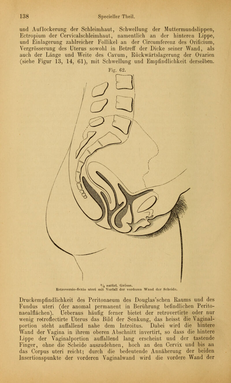 und Auflockerung der Schleimhaut, Schwellung der Muttermundslip pen, Ectropium der Cervicalschleimhaut, namentlich an der hinteren Lippe, und Einlagerung zahlreicher Follikel an der Circumferenz des Orificiura, Vergrösserung des Uterus sowohl in Betreff der Dicke seiner Wand, als auch der Länge und Weite des Cavum, Rückwärtslagerung der Ovarien (siehe Figur 13, 14, 61), mit Schwellung und Empfindlichkeit derselben. Fiar. 62. V3 natürl. Grösse. Retroversio-Hexio uteri mit Vorfall der vorderen Wand der Scheide. Druckempfindlichkeit des Peritonaeum des Douglas'schen Raums und des Fundus uteri (der anomal permanent in Berührung befindlichen Perito- naealflächen). Ueberaus häufig ferner bietet der retrovertirte oder nur wenig retroflectirte Uterus das Bild der Senkung, das heisst die Vaginal- portion steht auffallend nahe dem Introitus. Dabei wird die hintere Wand der Vagina in ihrem oberen Abschnitt invertirt, so dass die hintere Lippe der Vaginalportion auffallend lang erscheint und der tastende Finger, ohne die Scheide auszudehnen, hoch an den Cervix und bis an das Corpus uteri reicht; durch die bedeutende Annäherung der beiden Insertionspunkte der vorderen Vaginalwand wird die vordere Wand der
