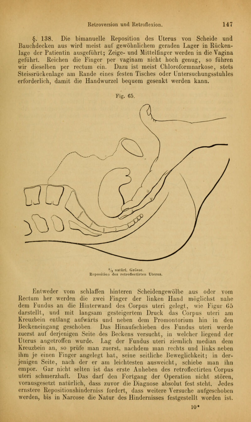 §. 138. Die bimanuelle Reposition des Uterus von Scheide und Bauchdecken aus wird meist auf gewöhnlichem geraden Lager in Rücken- lage der Patientin ausgeführt; Zeige-und Mittelfinger werden in die Vagina geführt. Reichen die Finger per vaginam nicht hoch genug, so führen wir dieselben per rectum ein. Dazu ist meist Chloroformnarkose, stets Steissrückenlage am Rande eines festen Tisches oder Untersuchungsstuhles erforderlich, damit die Handwurzel bequem gesenkt werden kann. Fig. 65. '/s nati'irl. Grosse. Reposition des retroflectirtcn Uterus. Entweder vom schlaffen hinteren Scheidengewölbe aus oder vom Rectum her werden die zwei Finger der linken Hand möglichst nahe dem Fundus an die Hinterwand des Corpus uteri gelegt, wie Figur 65 darstellt, und mit langsam gesteigertem Druck das Corpus uteri am Kreuzbein entlang aufwärts und neben dem Promontorium hin in den Beckeneingang gescholten Das Hinaufschieben des Fundus uteri weide zuerst auf derjenigen Seite des Beckens versucht, in welcher liegend der Uterus angetroffen wurde. Lag der Fundus uteri ziemlieh median dem Kreuzbein an, so prüfe man zuerst, nachdem man rechts und links neben ihm je einen Finger angelegt hat, seine seitliche Beweglichkeit; in der- jenigen Seite, nach der er am leichtesten ausweicht, schiebe man ihn empor. Gar nicht selten ist das erste Anheben des retroflectirten Corpus uteri schmerzhaft. Das darf den Fortgang der Operation nicht stören, vorausgesetzt natürlich, dass zuvor die Diagnose absolut lest steht. Jedes ernstere Repositionshinderniss fordert, dass weitere Versuche aufgeschoben werden, bis in Narcose die Natur des Hindernisses festgestellt worden ist. 10*