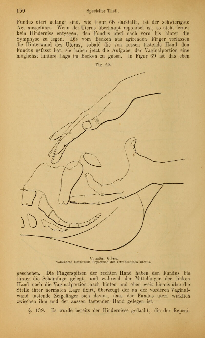 Fundus uteri gelangt sind, wie Figur 68 darstellt, ist der schwierigste Act ausgeführt. Wenn der Uterus überhaupt reponibel ist, so steht ferner kein Hinderniss entgegen, den Fundus uteri nach vorn bis hinter die Symphyse zu legen. Die vom Becken aus agirenden Finger verlassen die Hinterwand des Uterus, sobald die von aussen tastende Hand den Fundus gefasst hat, sie haben jetzt die Aufgabe, der Vaginalportion eine möglichst hintere Lage im Becken zu geben. In Figur 69 ist das eben Fig. 69. 1 s natürl. Grösse. Vollendete bimanuelle Reposition des retroflectirten Uterus. geschehen. Die Fingerspitzen der rechten Hand haben den Fundus bis hinter die Schamfuge gelegt, und während der Mittelfinger der linken Hand noch die Vaginalportion nach hinten und oben weit hinaus über die Stelle ihrer normalen Lage fixirt, überzeugt der an der vorderen Vaginal- wand tastende Zeigefinger sich davon, dass der Fundus uteri wirklich zwischen ihm und der aussen tastenden Hand gelegen ist. §. 139. Es wurde bereits der Hindernisse gedacht, die der Reposi-