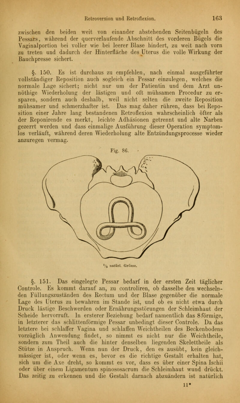 zwischen den beiden weit von einander abstehenden Seiten bügeln des Pessars, während der querverlaufende Abschnitt des vorderen Bügels die Vaginalportion bei voller wie bei leerer Blase hindert, zu weit nach vorn zu treten und dadurch der Hinterfläche des Uterus die volle Wirkung der Bauchpresse sichert. §. 150. Es ist durchaus zu empfehlen, nach einmal ausgeführter vollständiger Reposition auch sogleich ein Pessar einzulegen, welches die normale Lage sichert; nicht nur um der Patientin und dem Arzt un- nöthige Wiederholung der lästigen und oft mühsamen Procedur zu er- sparen, sondern auch deshalb, weil nicht selten die zweite Reposition mühsamer und schmerzhafter ist. Das mag daher rühren, dass bei Repo- sition einer Jahre lang bestandenen Retroflexion wahrscheinlich öfter als der Reponirende es merkt, leichte Adhäsionen getrennt und alte Narben gezerrt werden und dass einmalige Ausführung dieser Operation symptom- los verläuft, während deren Wiederholung alte Entzündungsprocesse wieder anzuregen vermag. Fig. 86. '/j natürl. Grosse. §. 151. Das eingelegte Pessar bedarf in der ersten Zeit täglicher Controle. Es kommt darauf an, zu controliren, ob dasselbe den wechseln- den Füllungszuständen des Rectum und der Blase gegenüber die normale Lage des Uterus zu bewahren im Stande ist, und ob es nicht etwa durch Druck lästige Beschwerden oder Ernährungsstörungen der Schleimhaut der Scheide hervorruft. In ersterer Beziehung bedarf namentlich das 8formige, in letzterer das schlittenförmige Pessar unbedingt dieser Controle. Da das leiztere bei schlaffer Vagina und schlaffen Weicht heilen des Beckenbodens vorzüglich Anwendung findet, so nimmt es nicht nur die Weichtheile, sondern zum Theil auch die hinter denselben liegenden Skeletthoile als Stütze in Anspruch. Wenn nun der Druck, den es ausübt, kein gleich- massiger ist, oder wenn es, bevor es die richtige Gestalt erhalten hat, sich um die Axe dreht, so kommt es vor, dass es über einer Spina Ischii oder über einem Ligamentum spinososacrum die Schleimhaut wund drückt. Das zeitig zu erkennen und die Gestalt darnach abzuändern ist natürlich 11*