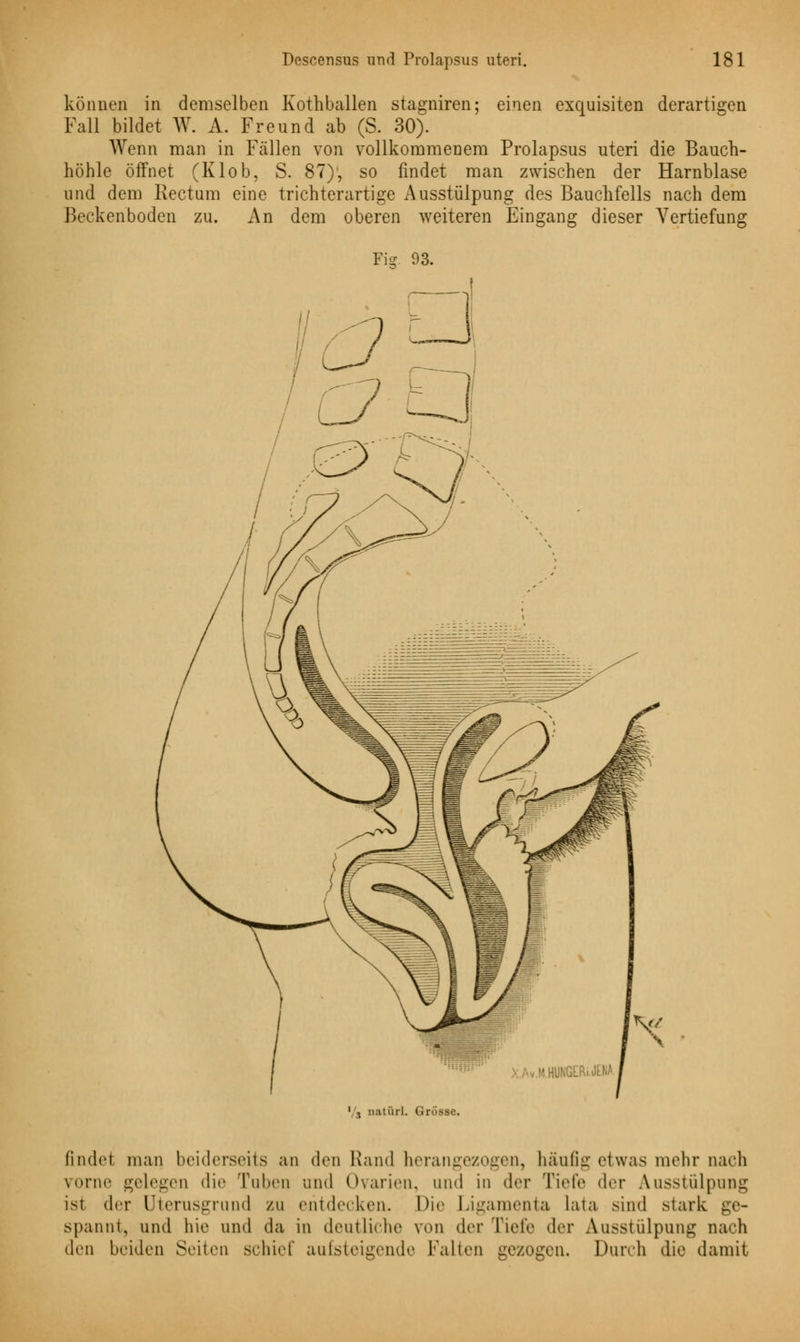 können in demselben Kothballen stagniren; einen exquisiten derartigen Fall bildet W. A. Freund ab (S. 30). Wenn man in Fällen von vollkommenem Prolapsus uteri die Bauch- höhle öffnet (Klob, S. 87), so findet man zwischen der Harnblase und dem Rectum eine trichterartige Ausstülpung des Bauchfells nach dem Beckenboden zu. An dem oberen weiteren Eingang dieser Vertiefung Fig. 93. 1 -, ostürL (i rosse. findet man beiderseits an den Rand herangezogen, häufig etwas mehr nach vorne gelegen die Tuben und Ovarien, und in der Tiefe der Ausstülpung ist der üterusgrnnd zu entdecken. Die Ligamenta Lata sind stark ge- spannt, und hie und da in deutliche von der Tiefe der Ausstülpung nach den beiden Seiten schief aufsteigende Palten gezogen. Duivh die damit