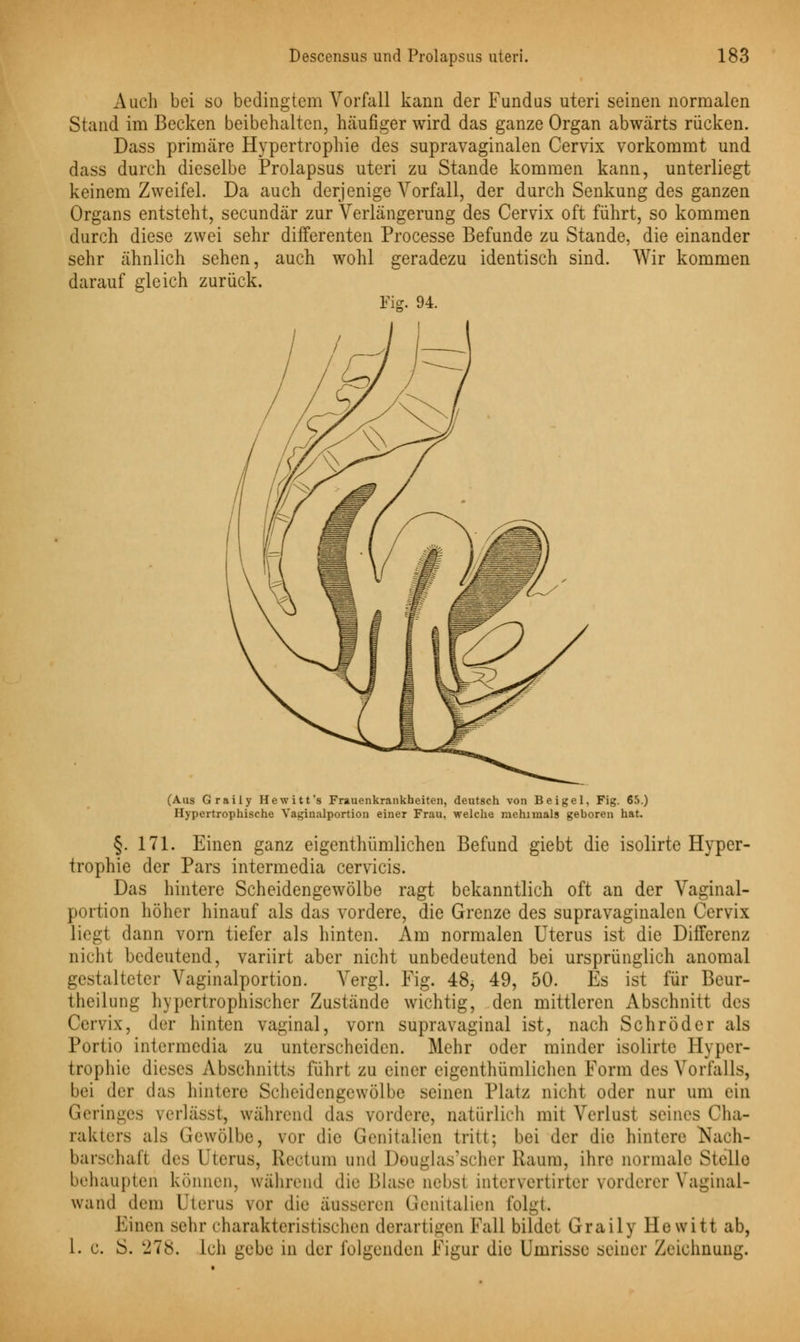 Auch bei so bedingtem Vorfall kann der Fundus uteri seinen normalen Stand im Becken beibehalten, häufiger wird das ganze Organ abwärts rücken. Dass primäre Hypertrophie des supravaginalen Cervix vorkommt und dass durch dieselbe Prolapsus uteri zu Stande kommen kann, unterliegt keinem Zweifel. Da auch derjenige Vorfall, der durch Senkung des ganzen Organs entsteht, seeundär zur Verlängerung des Cervix oft führt, so kommen durch diese zwei sehr differenten Processe Befunde zu Stande, die einander sehr ähnlich sehen, auch wohl geradezu identisch sind. Wir kommen darauf gleich zurück. Fig. 94. (Aus Graily Hewitt's Frauenkrankheiten, deutsch von Beigel, Fig. 65.) Hypertrophische Yagiualportion einer Frau, welche mehinials geboren hat. §. 171. Einen ganz eigentümlichen Befund giebt die isolirte Hyper- trophie der Pars intermedia cervicis. Das hintere Scheidengewölbe ragt bekanntlich oft an der Vaginal- portion höher hinauf als das vordere, die Grenze des supravaginalen Cervix liegt dann vorn tiefer als hinten. Am normalen Uterus ist die Differenz nicht bedeutend, variirt aber nicht unbedeutend bei ursprünglich anomal gestalteter Vaginalportion. Vergl. Fig. 48, 49, 50. Es ist für Beur- theilung hypertrophischer Zustände wichtig, den mittleren Abschnitt des Cervix, der hinten vaginal, vorn supravaginal ist, nach Schröder als Portio intermedia zu unterscheiden. Mehr oder minder isolirte Hyper- trophie dieses Abschnitts fährt zu einer eigenthümlichen Form des Vorfalls, bei der das hintere Scheidengewölbe seinen Platz nicht oder nur um ein Geringes verlässt, während das vordere, natürlich mit Verlust seines Cha- rakters als Gewölbe, vor die Genitalien tritt; bei der die hintere Nach- barschaft des Uterus, Rectum und DöUglas'scher Kaum, ihre normale Stelle behaupten können, während die Blase nebst intervertirter vorderer Vaginal- wand dem Uterus vor die äusseren Genitalien folgt Einen sehr charakteristischen derartigen Fall bildet Graily Hewitt ab, 1. c. S. 'J7<s. Ich gebe in der folgenden Figur die Umrisse seiner Zeichnung.