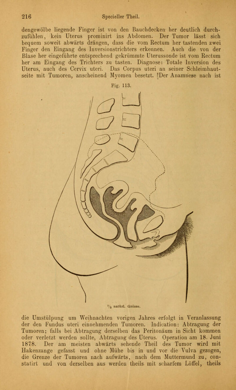 dengewölbe liegende Finger ist von den Bauchdecken her deutlich durch- zufühlen, kein Uterus prominirt ins Abdomen. Der Tumor lässt sich bequem soweit abwärts drängen, dass die vom Rectum her tastenden zwei Finger den Eingang des Inversionstrichters erkennen. Auch die von der Blase her eingeführte entsprechend gekrümmte Uterussonde ist vom Rectum her am Eingang des Trichters zu tasten. Diagnose: Totale Inversion des Uterus, auch des Cervix uteri. Das Corpus uteri an seiner Schleimhaut- seite mit Tumoren, anscheinend Myomen besetzt. Wer Anamnese nach ist Fig. 113. V3 natürl. Grösse. die Umstülpung um Weihnachten vorigen Jahres erfolgt in Veranlassung der den Fundus uteri einnehmenden Tumoren. Indication: Abtragung der Tumoren; falls bei Abtragung derselben das Peritonäum in Sicht kommen oder verletzt werden sollte, Abtragung des Uterus. Operation am 18. Juni 1878. Der am meisten abwärts sehende Theil des Tumor wird mit Hakenzange gefasst und ohne Mühe bis in und vor die Vulva gezogen, die Grenze der Tumoren nach aufwärts, nach dem Muttermund zu, con- statirt und von derselben aus werden theils mit scharfem Löffel, theils