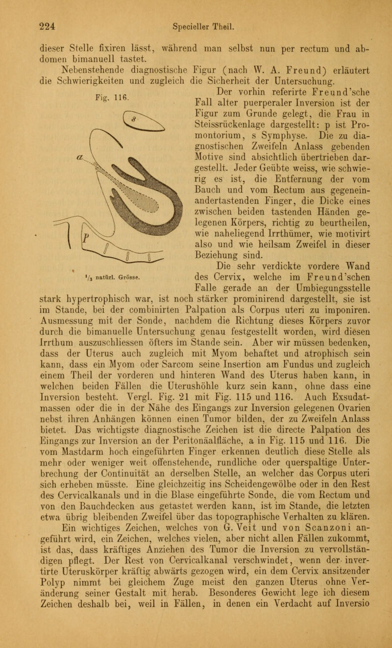 Fig. 116. l/3 natürl. Grösse. dieser Stelle fixiren lässt, während man selbst nun per rectum und ab- domen bimanuell tastet. Nebenstehende diagnostische Figur (nach W. A. Freund) erläutert die Schwierigkeiten und zugleich die Sicherheit der Untersuchung. Der vorhin referirte Freund'sehe Fall alter puerperaler Inversion ist der Figur zum Grunde gelegt, die Frau in Steissrückenlage dargestellt: p ist Pro- montorium, s Symphyse. Die zu dia- gnostischen Zweifeln Anlass gebenden Motive sind absichtlich übertrieben dar- gestellt. Jeder Geübte weiss, wie schwie- rig es ist, die Entfernung der vom Bauch und vom Rectum aus gegenein- andertastenden Finger, die Dicke eines zwischen beiden tastenden Händen ge- legenen Körpers, richtig zu beurtheilen, wie naheliegend Irrthümer, wie motivirt also und wie heilsam Zweifel in dieser Beziehung sind. Die sehr verdickte vordere Wand des Cervix, welche im Freund'sehen Falle gerade an der Umbiegungsstelle stark hypertrophisch war, ist noch stärker prominirend dargestellt, sie ist im Stande, bei der combinirten Palpation als Corpus uteri zu imponiren. Ausmessung mit der Sonde, nachdem die Richtung dieses Körpers zuvor durch die bimanuelle Untersuchung genau festgestellt worden, wird diesen Irrthum auszuschliessen öfters im Stande sein. Aber wir müssen bedenken, dass der Uterus auch zugleich mit Myom behaftet und atrophisch sein kann, dass ein Myom oder Sarcom seine Insertion am Fundus und zugleich einem Theil der vorderen und hinteren Wand des Uterus haben kann, in welchen beiden Fällen die Uterushöhle kurz sein kann, ohne dass eine Inversion besteht. Vergl. Fig. 21 mit Fig. 115 und 116. Auch Exsudat- massen oder die in der Nähe des Eingangs zur Inversion gelegenen Ovarien nebst ihren Anhängen können einen Tumor bilden, der zu Zweifeln Anlass bietet. Das wichtigste diagnostische Zeichen ist die directe Palpation des Eingangs zur Inversion an der Peritonäalfläche, a in Fig. 115 und 116. Die vom Mastdarm hoch eingeführten Finger erkennen deutlich diese Stelle als mehr oder weniger weit offenstehende, rundliche oder querspaltige Unter- brechung der Continuität an derselben Stelle, an welcher das Corpus uteri sich erheben müsste. Eine gleichzeitig ins Scheidengewölbe oder in den Rest des Cervicalkanals und in die Blase eingeführte Sonde, die vom Rectum und von den Bauchdecken aus getastet werden kann, ist im Stande, die letzten etwa übrig bleibenden Zweifel über das topographische Verhalten zu klären. Ein wichtiges Zeichen, welches von G. Veit und von Scanzoni an- geführt wird, ein Zeichen, welches vielen, aber nicht allen Fällen zukommt, ist das, dass kräftiges Anziehen des Tumor die Inversion zu vervollstän- digen pflegt. Der Rest von Cervicalkanal verschwindet, wenn der-inver- tirte Uteruskörper kräftig abwärts gezogen wird, ein dem Cervix ansitzender Polyp nimmt bei gleichem Zuge meist den ganzen Uterus ohne Ver- änderung seiner Gestalt mit herab. Besonderes Gewicht lege ich diesem Zeichen deshalb bei, weil in Fällen, in denen ein Verdacht auf Inversio