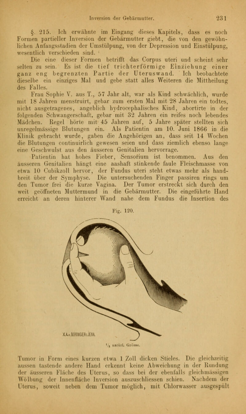 §. '215. Ich erwähnte im Eingang dieses Kapitels, dass es noch Formen partieller Inversion der Gebärmutter giebt, die von den gewöhn- lichen Anfangsstadien der Umstülpung, von der Depression und Einstülpung, wesentlich verschieden sind. ' Die eine dieser Formen betrifft das Corpus uteri und scheint sehr selten zu sein. Es ist die tief trichterförmige Einziehung einer ganz eng begrenzten Partie der Uteruswand. Ich beobachtete dieselbe ein einziges Mal und gebe statt alles Weiteren die Mittheilung des Fall«-. Frau Sophie V. aus T., 57 Jahr alt, war als Kind schwächlich, wurde mit 18 Jahren menstruirt, gebar zum ersten Mal mit 28 Jahren ein todtes, nicht ausgetragenes, angeblich hydrocephalisches Kind, abortirte in der folgenden Schwangerschaft, gebar mit 32 Jahren ein reifes noch lebendes Mädchen. Regel hörte mit 45 Jahren auf, 5 Jahre später stellten sich unregelmässige Blutungen ein. Als Patientin am 10. Juni 1866 in die Klinik gebracht wurde, gaben die Angehörigen an, dass seit 14 Wochen die Blutungen continuirlich gewesen seien und dass ziemlich ebenso lange eine Geschwulst aus den äusseren Genitalien hervorrage. Patientin hat hohes Fieber, Sensofium ist benommen. Aus den äusseren Genitalien hängt eine aashaft stinkende faule Fleischmasse von etwa 10 Cubikzoll hervor, der Fundus uteri steht etwas mehr als hand- breit über der Symphyse. Die untersuchenden Finger passiren rings um den Tumor frei die kurze Vagina. Der Tumor erstreckt sich durch den weit geöffneten Muttermund in die Gebärmutter. Die eingeführte Hand erreicht an deren hinterer Wand nahe dem Fundus die Insertion des Fig. 120. 1 ^ n.Miill. (i' Tumor in Form eines kurzen etwa l /oll dicken Stieles. Die gleichzeitig aussen tastende andere Band erkenni keine Abweichung In der Rundung der äusseren Fläche des Uterus, so dass hei der ebenfalls gleich massigen Wölbung der Innenfläche Inversion auszuschliessen schien. Nachdem der Uterus, soweit neben dein Tumor möglich, um Chlorwasser ausgespült