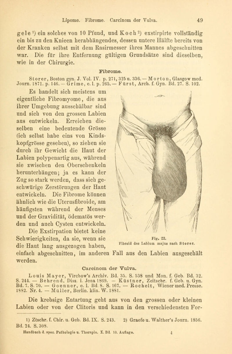 gele ') ein solches von 10 Pfand, und Koch2) exstirpirte vollständig ein bis zu den Knieen herabhängendes, dessen untere Hälfte bereits von der Kranken selbst mit dem Rasirmesser ihres Mannes abgeschnitten war. Die für ihre Entfernung gültigen Grundsätze sind dieselben, wie in der Chirurgie. Fibrome. Stör er, Boston gyn. J. Vol. IV. p. 271, 325 u. 336. — Morton, Glasgow med. Journ. 1871. p. 146. — Grime, e. 1. p.265.— Fürst, Ar eh. f. Gyn. Bd. 27. S. 102. Es handelt sich meistens um eigentliche Fibromyome, die aus ihrer Umgebung ausschälbar sind und sich von den grossen Labien aus entwickeln. Erreichen die- selben eine bedeutende Grösse (ich selbst habe eins von Kinds- kopfgrösse gesehen), so ziehen sie durch ihr Gewicht die Haut der Labien polypenartig aus, während sie zwischen den Oberschenkeln herunterhängen; ja es kann der Zug so stark werden, dass sich ge- schwürige Zerstörungen der Haut entwickeln. Die Fibrome können ähnlich wie die Uterusfibroide, am häufigsten während der Menses und der Gravidität, ödematös wer- den und auch Cysten entwickeln. Die Exstirpation bietet keine Schwierigkeiten, da sie, wenn sie die Haut lang ausgezogen haben, einfach abgeschnitten, im anderen Fall aus den Labien ausgeschält werden. Carcinom der Vulva. Louis Mayer, Virchow's Archiv. Bd. 35. S. 538 und Mon. f. Geb. Bd. 32. S. 244. — Behrend. Diss. i. Jena 1869. — Küstner, Zeitschr. f. Geb. u. Gyn. Bd. 7. S. 70. — Goenner, e. 1. Bd. 8. S. 167. — Rochelt, Wiener med. Presse. 1882. Nr. 4. — Müller, Berlin, klin. W. 1881. Die krebsige Entartung geht aus von den grossen oder kleinen Labien oder von der Clitoris und kann in den verschiedensten For- Fig. 23. Fibroid des Labium. majus nach Stör er. 1) Ztschr. f. Chir. u. Geb. Bd. IX. S. 243. 2) Graefe u. Walther's Journ. 1856. Bd. 24. S.308. Handbuch d. spec. Pathologie u. Therapie. X. Bd. 10. Auflage. 4