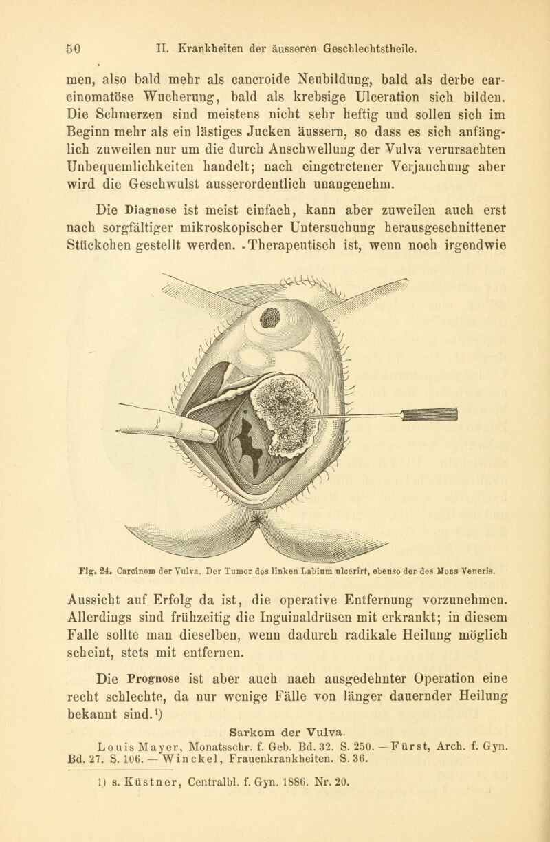 men, also bald mehr als cancroide Neubildung, bald als derbe car- cinomatöse Wucherung, bald als krebsige Ulceration sich bilden. Die Schmerzen sind meistens nicht sehr heftig und sollen sich im Beginn mehr als ein lästiges Jucken äussern, so dass es sich anfäng- lich zuweilen nur um die durch Anschwellung der Vulva verursachten Unbequemlichkeiten handelt; nach eingetretener Verjauchung aber wird die Geschwulst ausserordentlich unangenehm. Die Diagnose ist meist einfach, kann aber zuweilen auch erst nach sorgfältiger mikroskopischer Untersuchung herausgeschnittener Stückchen gestellt werden. -Therapeutisch ist, wenn noch irgendwie Fig. 24. Careinom der Vulva. Der Tumor des linken Labium ulcerirt, obenso der des Moes Veneris. Aussicht auf Erfolg da ist, die operative Entfernung vorzunehmen. Allerdings sind frühzeitig die Inguinaldrüsen mit erkrankt; in diesem Falle sollte man dieselben, wenn dadurch radikale Heilung möglich scheint, stets mit entfernen. Die Prognose ist aber auch nach ausgedehnter Operation eine recht schlechte, da nur wenige Fälle von länger dauernder Heilung bekannt sind.1) Sarkom der Vulva. LouisMayer, Monatsschr. f. Geb. Bd. 32. S. 250.-Fürst, Arch. f. Gyn. Bd. 27. S. 106.— Win ekel, Frauenkrankheiten. S. 36. 1) s. Küstner, Centralbl. f. Gyn. 1886. Nr. 20.