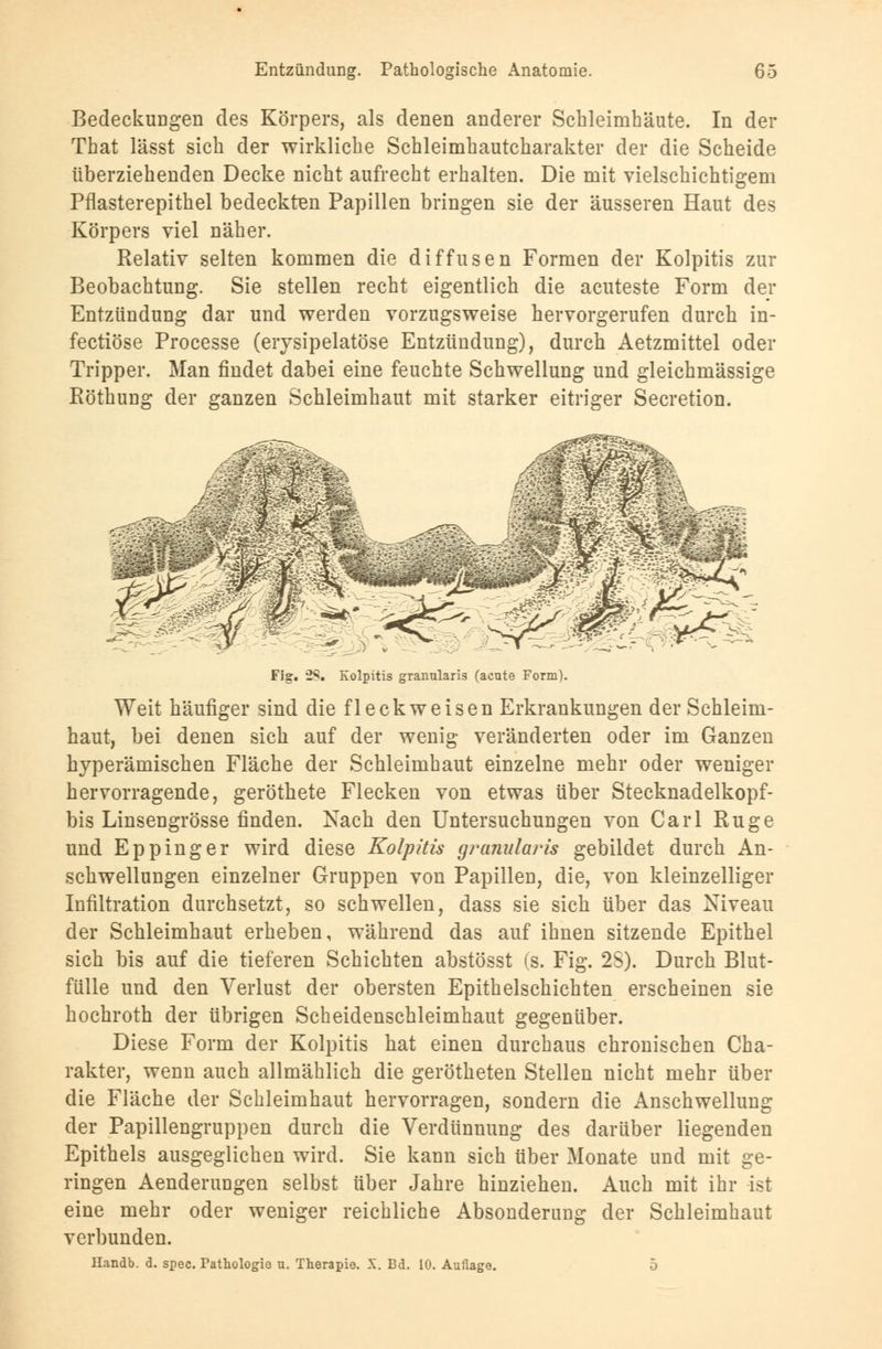 Bedeckungen des Körpers, als denen anderer Schleimhäute. In der That lässt sich der wirkliche Schleimhautcharakter der die Scheide überziehenden Decke nicht aufrecht erhalten. Die mit vielschichtigem Pflasterepithel bedeckten Papillen bringen sie der äusseren Haut des Körpers viel näher. Relativ selten kommen die diffusen Formen der Kolpitis zur Beobachtung. Sie stellen recht eigentlich die acuteste Form der Entzündung dar und werden vorzugsweise hervorgerufen durch in- fectiöse Processe (erysipelatöse Entzündung), durch Aetzmittel oder Tripper. Man findet dabei eine feuchte Schwellung und gleichmässige Röthung der ganzen Schleimhaut mit starker eitriger Secretion. Fig. -2$. Kolpitis granularis (acute Form). Weit häufiger sind die fleck weisen Erkrankungen der Schleim- haut, bei denen sich auf der wenig veränderten oder im Ganzen hyperämischen Fläche der Schleimhaut einzelne mehr oder weniger hervorragende, geröthete Flecken von etwas über Stecknadelkopf- es Linsengrösse finden. Nach den Untersuchungen von Carl Rüge und Eppinger wird diese Kolpitis granularis gebildet durch An- schwellungen einzelner Gruppen von Papillen, die, von kleinzelliger Infiltration durchsetzt, so schwellen, dass sie sich über das Niveau der Schleimhaut erheben, während das auf ihnen sitzende Epithel sich bis auf die tieferen Schichten abstösst (s. Fig. 25). Durch Blut- fülle und den Verlust der obersten Epithelschichten erscheinen sie hochroth der übrigen Scheidenschleimhaut gegenüber. Diese Form der Kolpitis hat einen durchaus chronischen Cha- rakter, wenn auch allmählich die gerötheten Stellen nicht mehr über die Fläche der Schleimhaut hervorragen, sondern die Anschwellung der Papillengruppen durch die Verdünnung des darüber liegenden Epithels ausgeglichen wird. Sie kann sich über Monate und mit ge- ringen Aenderungen selbst über Jahre hinziehen. Auch mit ihr ist eine mehr oder weniger reichliche Absonderung der Schleimhaut verbunden. Ilandb. d. spec. Pathologie u. Therapie. X. Bd. 10. Auflage. 5