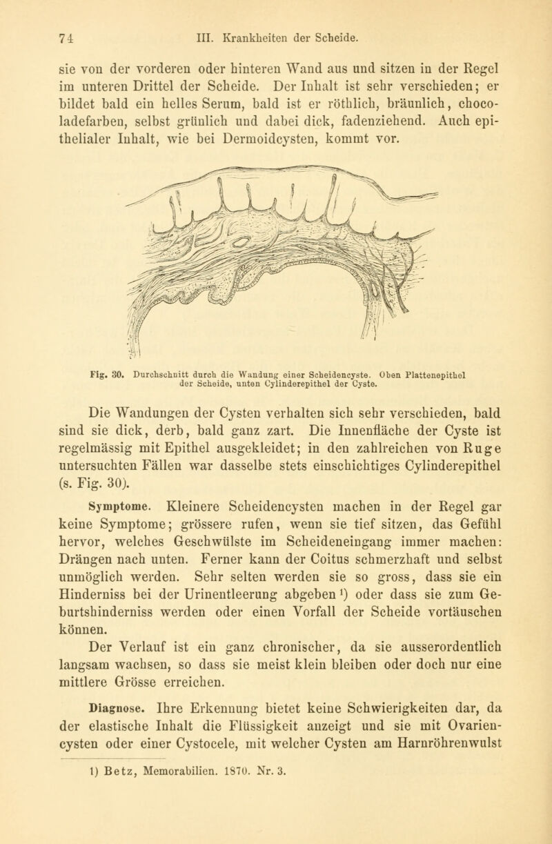 sie von der vorderen oder hinteren Wand aus und sitzen in der Regel im unteren Drittel der Scheide. Der Inhalt ist sehr verschieden; er bildet bald ein helles Serum, bald ist er röthlich, bräunlich, choco- ladefarben, selbst grünlich und dabei dick, fadenziehend. Auch epi- thelialer Inhalt, wie bei Dermoidcysten, kommt vor. Fig. 30. Durchschnitt durch die Wandung einer Scheidencyste. Oben Plattenepithel der Scheide, unten Cylinderepithel der Cyste. Die Wandungen der Cysten verhalten sich sehr verschieden, bald sind sie dick, derb, bald ganz zart. Die Innenfläche der Cyste ist regelmässig mit Epithel ausgekleidet; in den zahlreichen von Rüge untersuchten Fällen war dasselbe stets einschichtiges Cylinderepithel (s. Fig. 30). Symptome. Kleinere Scheidencysten machen in der Regel gar keine Symptome; grössere rufen, wenn sie tief sitzen, das Gefühl hervor, welches Geschwülste im Scheideneingang immer machen: Drängen nach unten. Ferner kann der Coitus schmerzhaft und selbst unmöglich werden. Sehr selten werden sie so gross, dass sie ein Hinderniss bei der Urinentleerung abgeben *) oder dass sie zum Ge- burtshinderniss werden oder einen Vorfall der Scheide vortäuschen können. Der Verlauf ist ein ganz chronischer, da sie ausserordentlich langsam wachsen, so dass sie meist klein bleiben oder doch nur eine mittlere Grösse erreichen. Diagnose. Ihre Erkennung bietet keine Schwierigkeiten dar, da der elastische Inhalt die Flüssigkeit anzeigt und sie mit Ovarien- cysten oder einer Cystocele, mit welcher Cysten am Harnröhrenwulst 1) Betz, Memorabilien. 1870. Nr. 3.