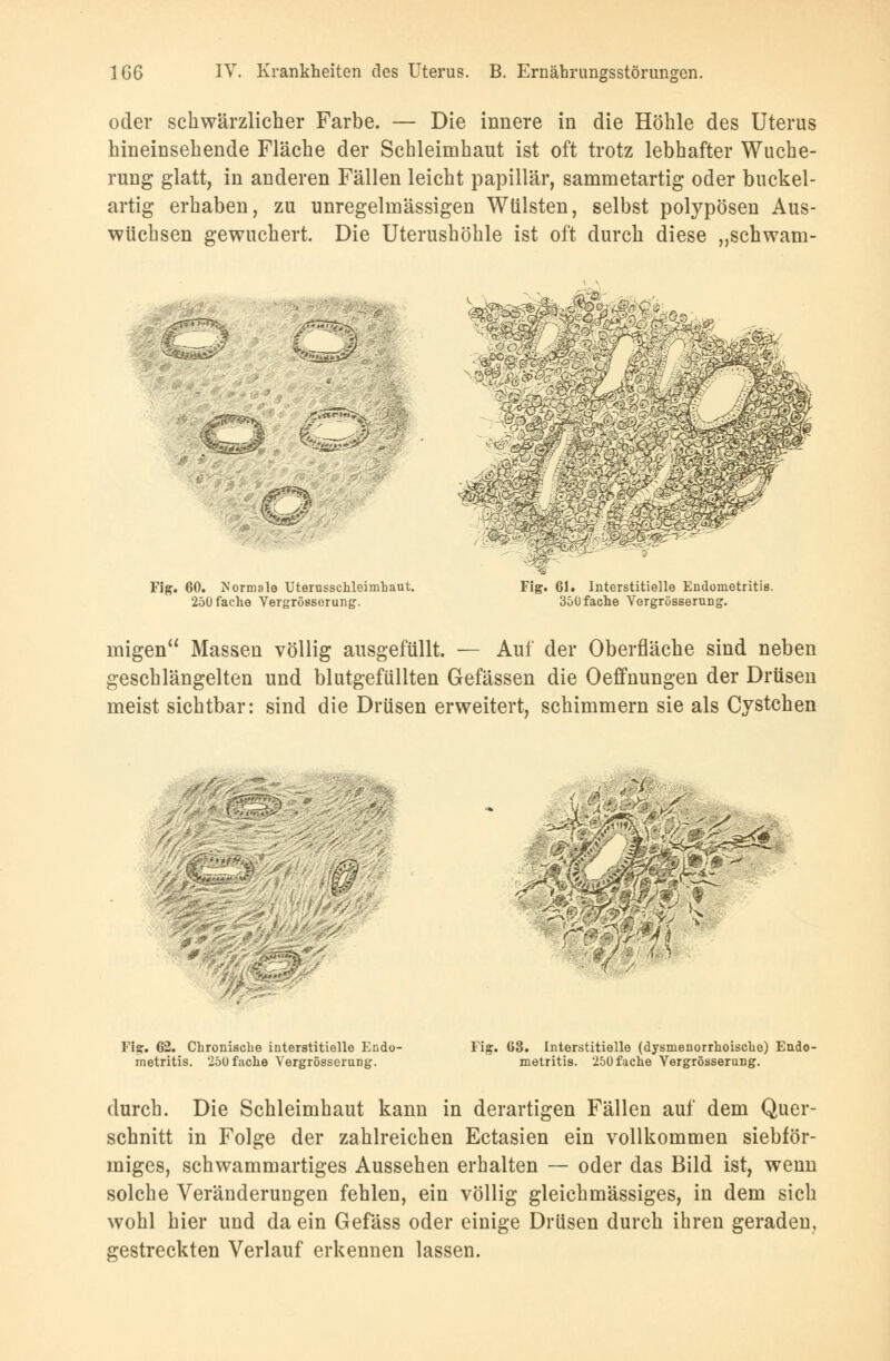 oder schwärzlicher Farbe. — Die innere in die Höhle des Uterus hineinsehende Fläche der Schleimhaut ist oft trotz lebhafter Wuche- rung glatt, in anderen Fällen leicht papillär, sammetartig oder buckel- artig erhaben, zu unregehnässigen Wülsten, selbst polypösen Aus- wüchsen gewuchert. Die Uterushöhle ist oft durch diese „schwatn- <& IfcZJß £P*5S Ol ^ ]m§fiMm&m„* Fig. 60. Normale Uterusschleiinhaut. 250 fache Vergrössorung. Fig. 61. Interstitielle Endometritis. 35Ü fache Vergrössorung. niigen Massen völlig ausgefüllt. — Auf der Oberfläche sind neben geschlängelten und blutgefüllten Gefässen die Oeffnungen der Drüsen meist sichtbar: sind die Drüsen erweitert, schimmern sie als Cystchen 4 % • Fig. 62. Chronische interstitielle Endo- metritis. 25U fache Vergrößerung. Fig. 63. Interstitielle (dysmenorrhoische) Endo- metritis. 250 fache Vergrössorung. durch. Die Schleimhaut kann in derartigen Fällen auf dem Quer- schnitt in Folge der zahlreichen Ectasien ein vollkommen siebför- miges, schwammartiges Aussehen erhalten — oder das Bild ist, wenn solche Veränderungen fehlen, ein völlig gleichmässiges, in dem sich wohl hier und da ein Gefäss oder einige Drüsen durch ihren geraden, gestreckten Verlauf erkennen lassen.