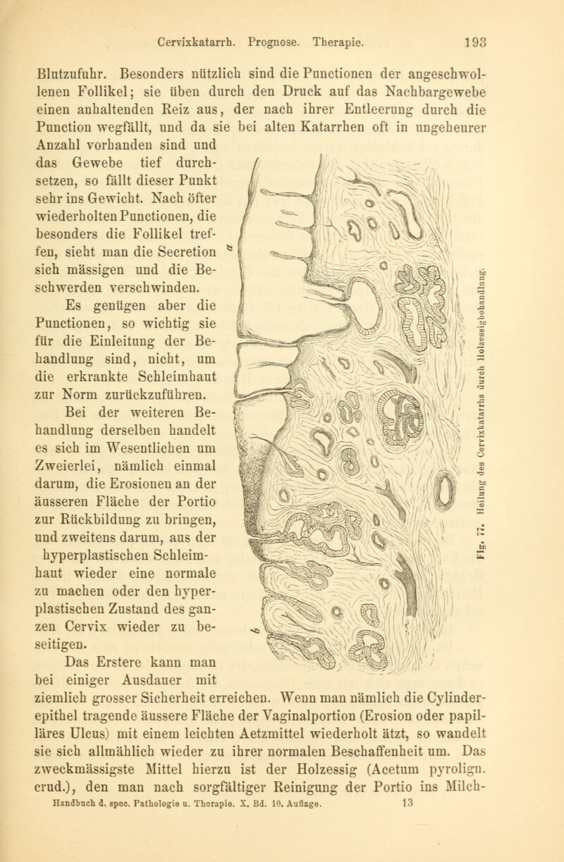Blutzufuhr. Besonders nützlicb sind die Punctionen der angeschwol- lenen Follikel; sie üben durch den Druck auf das Nachbargewebe einen anhaltenden Reiz aus, der nach ihrer Entleerung durch die Punction wegfällt, und da sie bei alten Katarrhen oft in ungeheurer Anzahl vorhanden sind und das Gewebe tief durch- setzen, so fällt dieser Punkt sehr ins Gewicht. Nach öfter wiederholten Punctionen, die besonders die Follikel tref- fen, sieht man die Secretion sich massigen und die Be- schwerden verschwinden. Es genügen aber die Punctionen, so wichtig sie für die Einleitung der Be- handlung sind, nicht, um die erkrankte Schleimhaut zur Norm zurückzuführen. Bei der weiteren Be- handlung derselben handelt es sich im Wesentlichen um Zweierlei, nämlich einmal darum, die Erosionen an der äusseren Fläche der Portio zur Rückbildung zu bringen, und zweitens darum, aus der hyperplastischen Schleim- haut wieder eine normale zu machen oder den hyper- plastischen Zustand des gan- zen Cervix wieder zu be- seitigen. Das Erstere kann man bei einiger Ausdauer mit ziemlich grosser Sicherheit erreichen. Wenn man nämlich die Cylinder- epithel tragende äussere Fläche der Vaginalportion (Erosion oder papil- läres Ulcus) mit einem leichten Aetzmittel wiederholt ätzt, so wandelt sie sich allmählich wieder zu ihrer normalen Beschaffenheit um. Das zweckmässigste Mittel hierzu ist der Holzessig (Acetum pyrolign. crud.), den man nach sorgfältiger Reinigung der Portio ins Milch- Handbuch d. spoc. Pathologie u. Therapie. X. Bd. 10. Auflage. 13